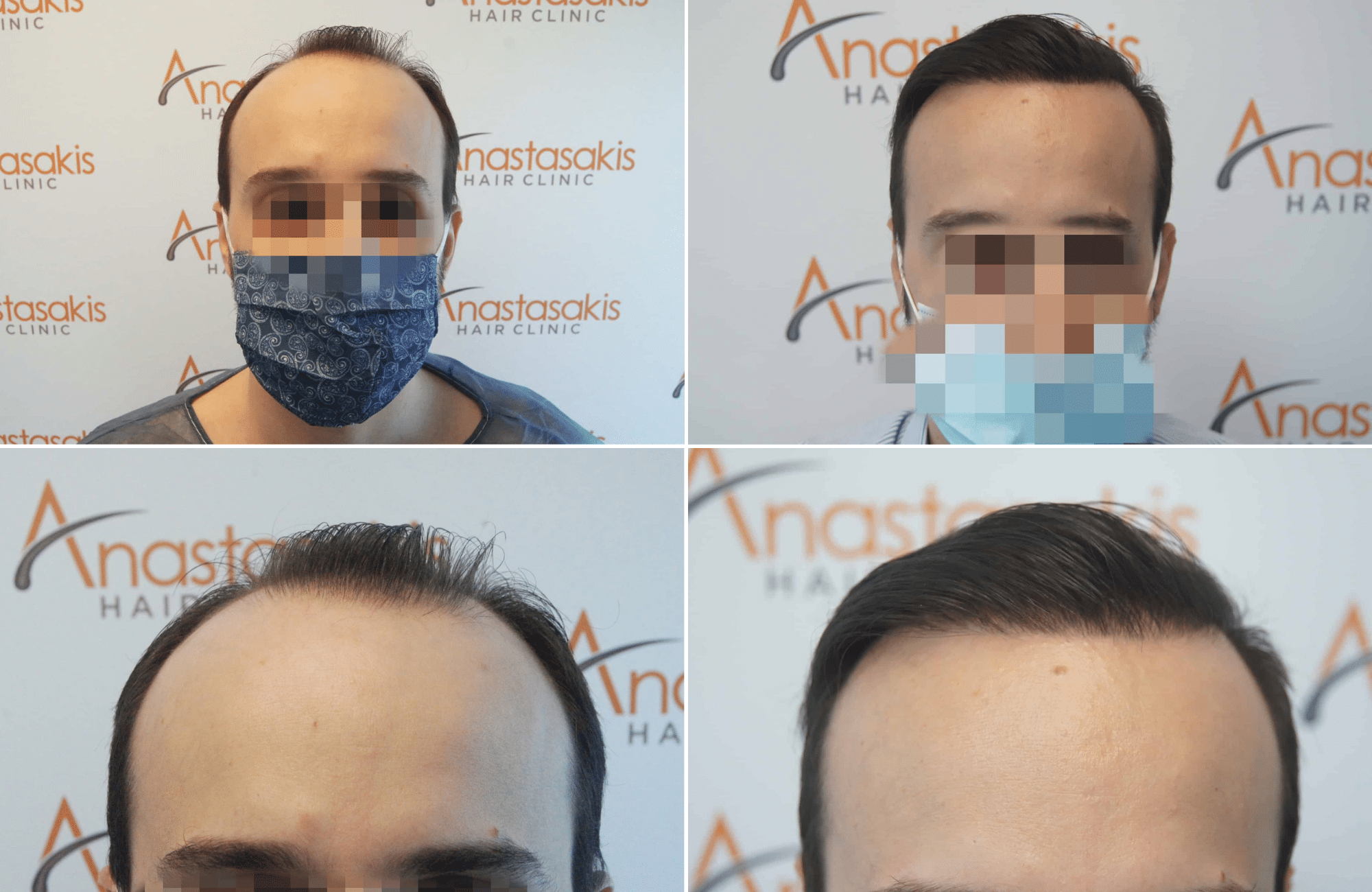 https://www.anastasakishairclinic.gr/portfolio/apotelesma-metamosxefsis-mallion-anastasakis-hair-clinic-330/