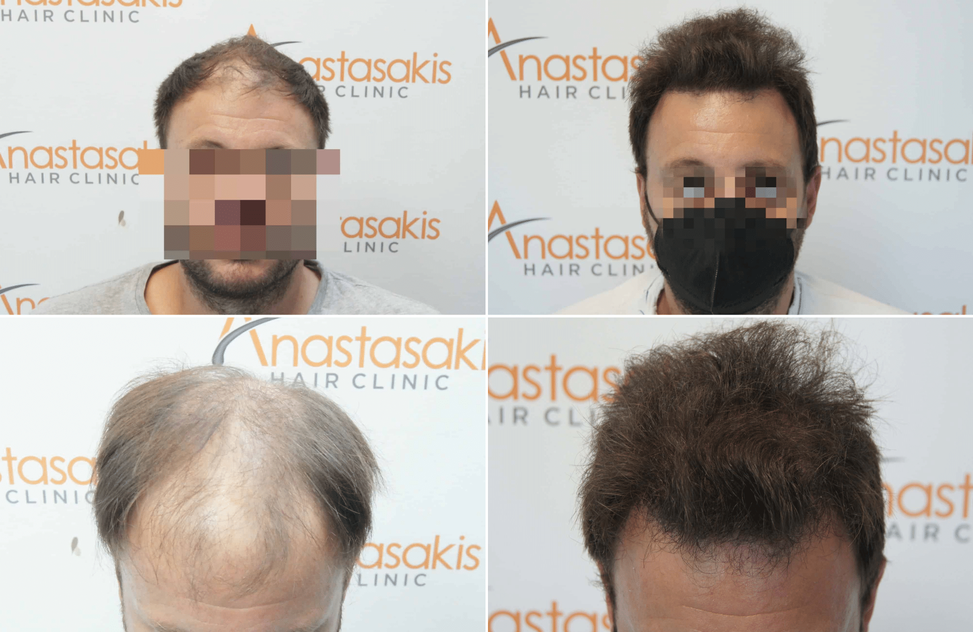 https://www.anastasakishairclinic.gr/portfolio/apotelesma-metamosxefsis-mallion-anastasakis-hair-clinic-315/