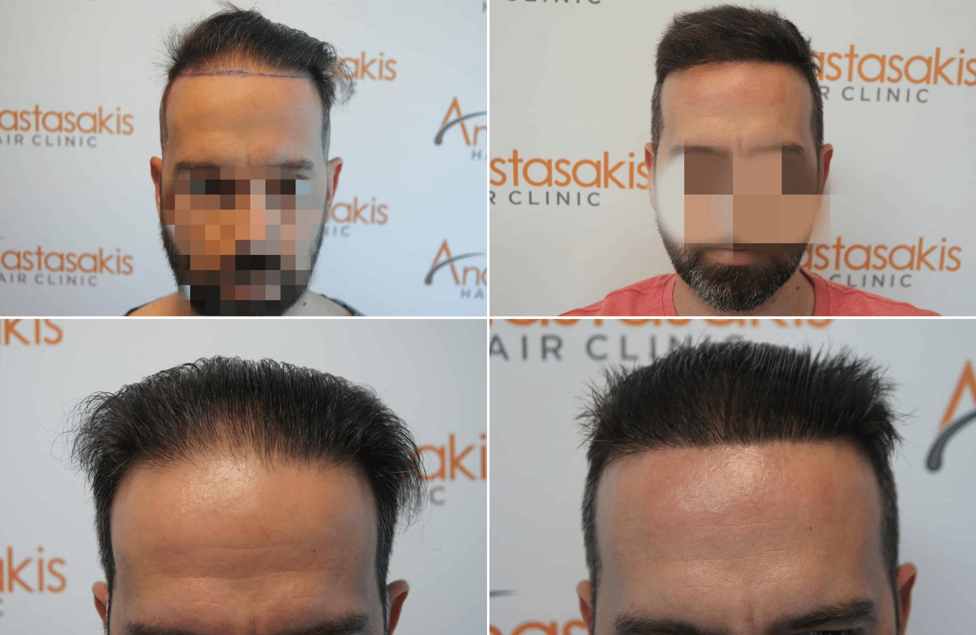 https://www.anastasakishairclinic.gr/portfolio/apotelesma-metamosxefsis-mallion-anastasakis-hair-clinic-316/