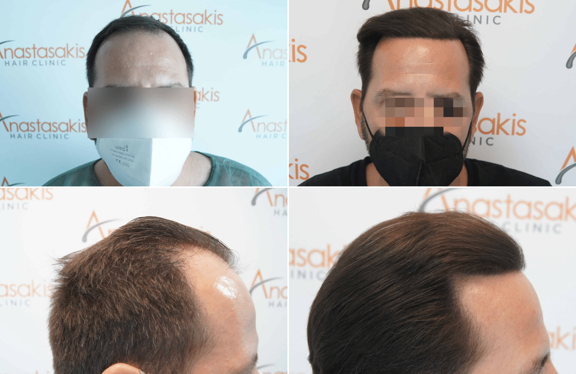 https://www.anastasakishairclinic.gr/portfolio/apotelesma-metamosxefsis-mallion-anastasakis-hair-clinic-317/