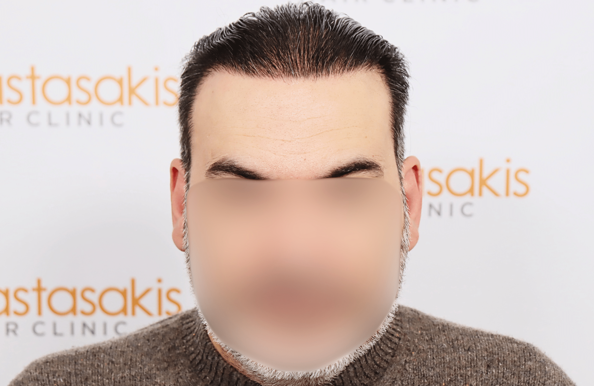 hair transplant result 3500 fus stage 6