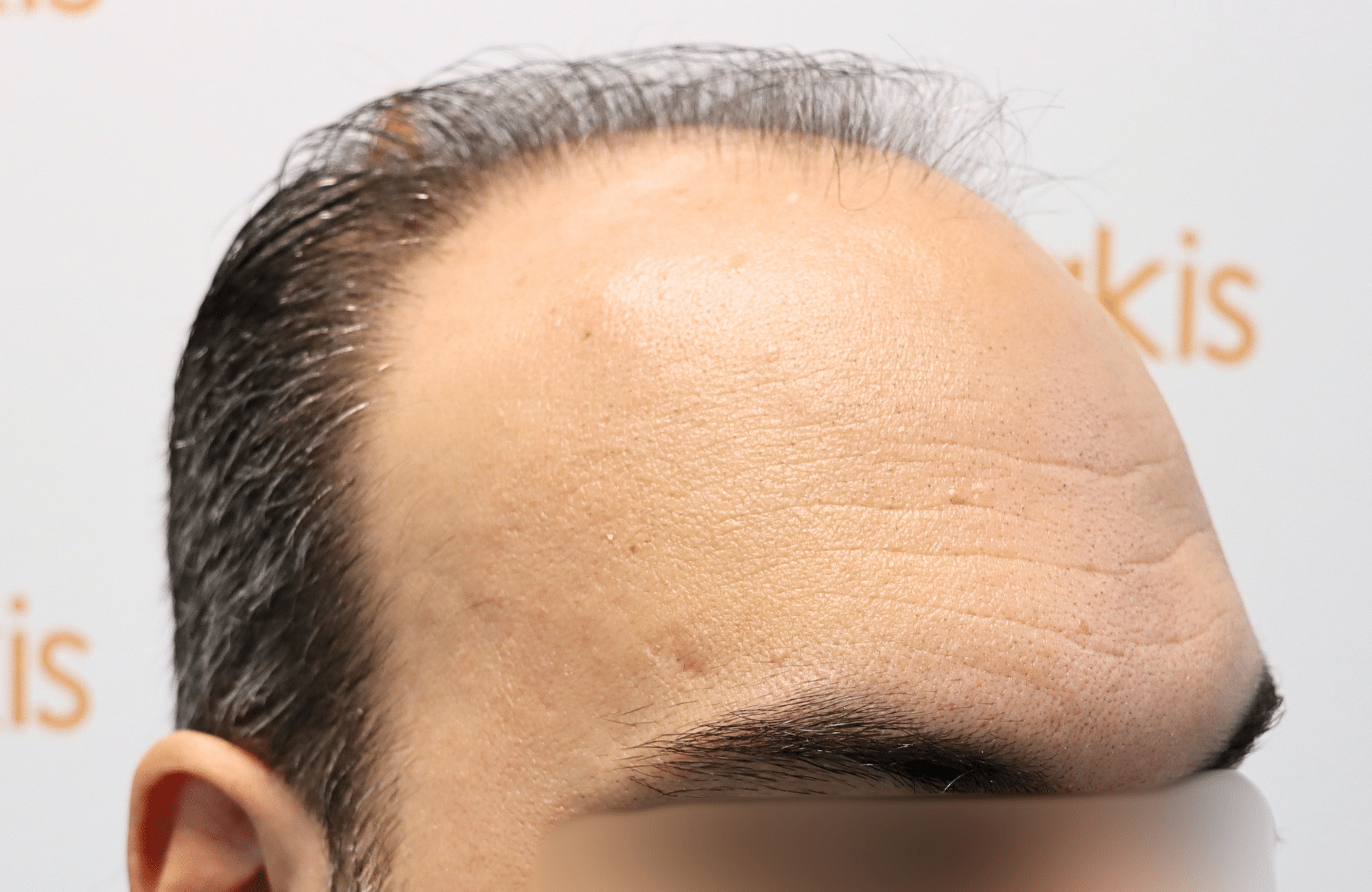 hair transplant result 3500 fus stage 6