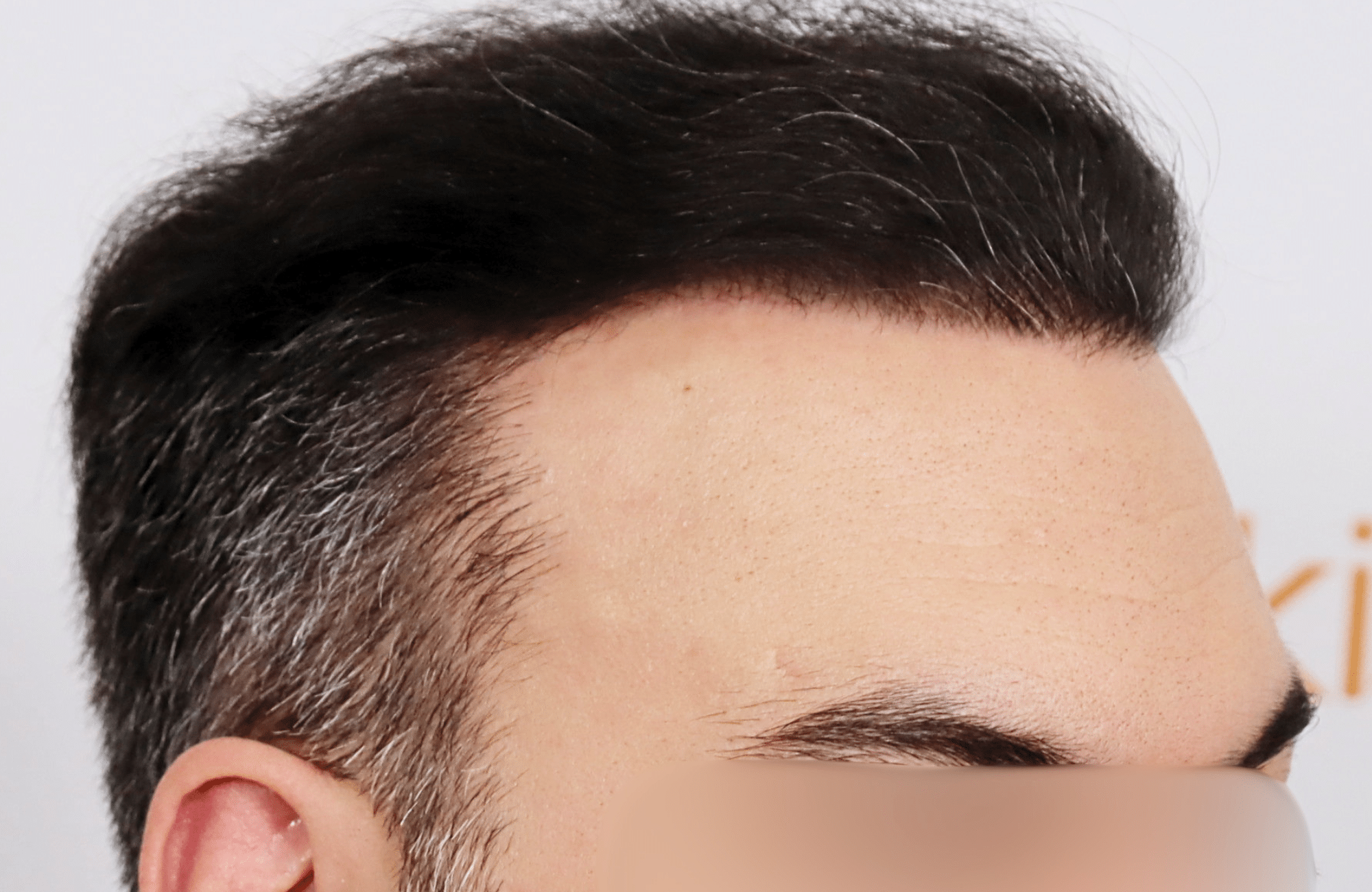 hair transplant result 3500 fus stage 6