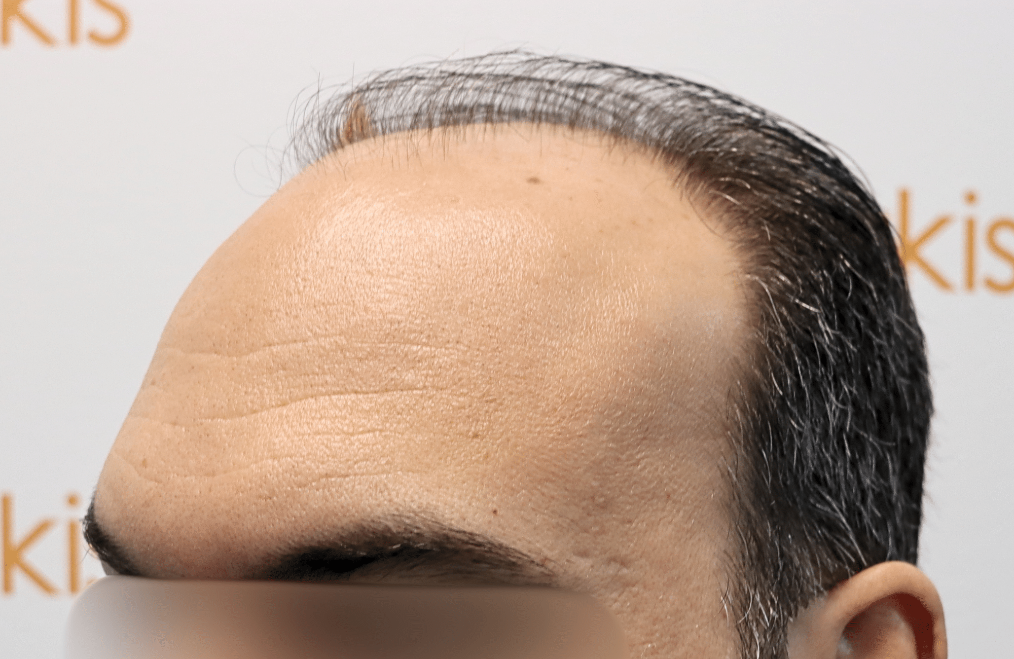 hair transplant result 3500 fus stage 6