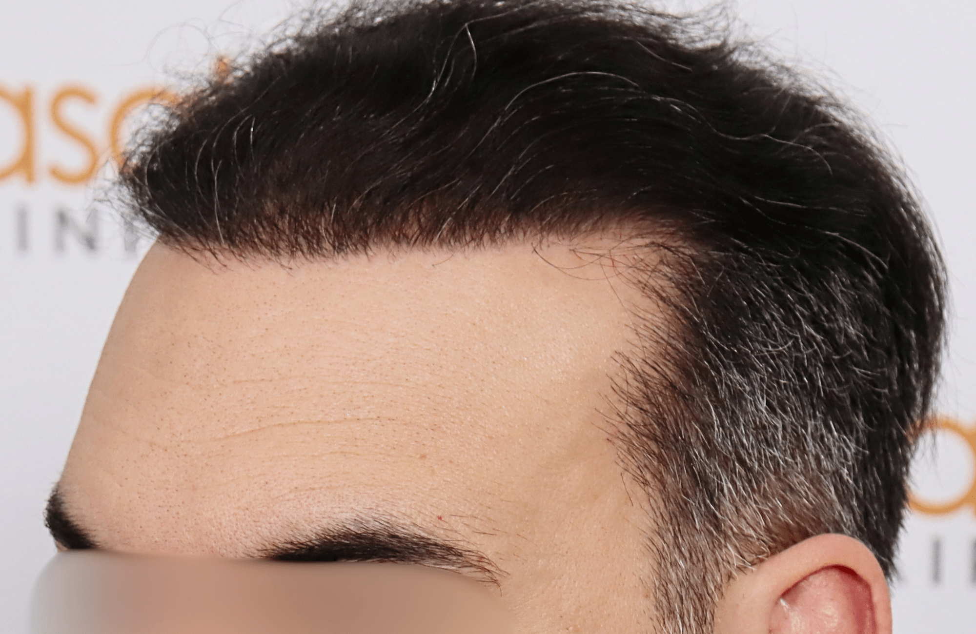hair transplant result 3500 fus stage 6