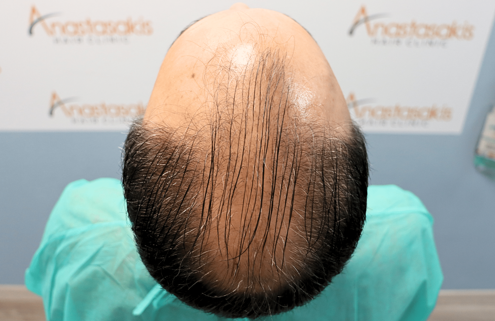 hair transplant result 3500 fus stage 6