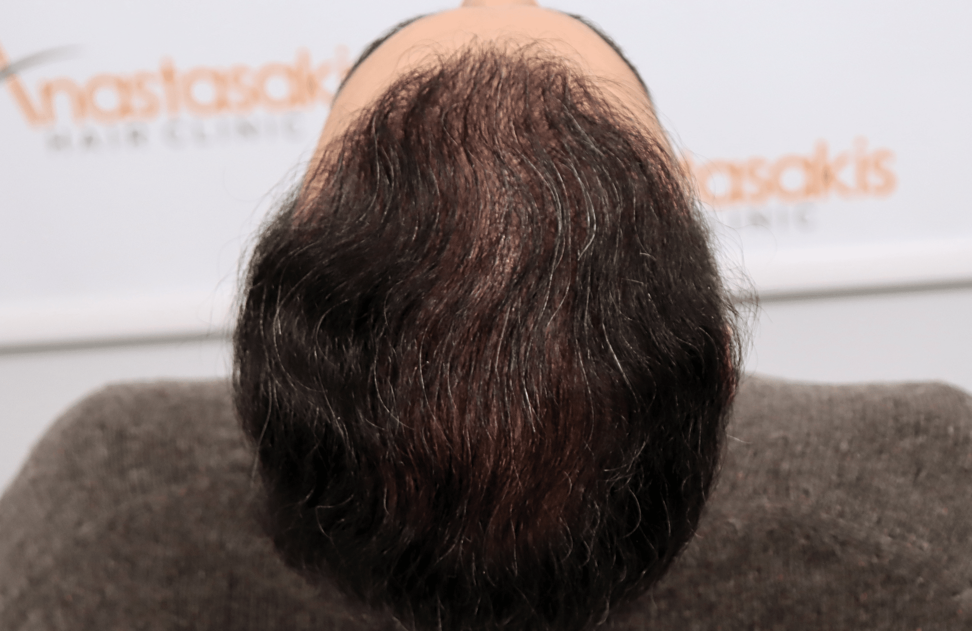 hair transplant result 3500 fus stage 6