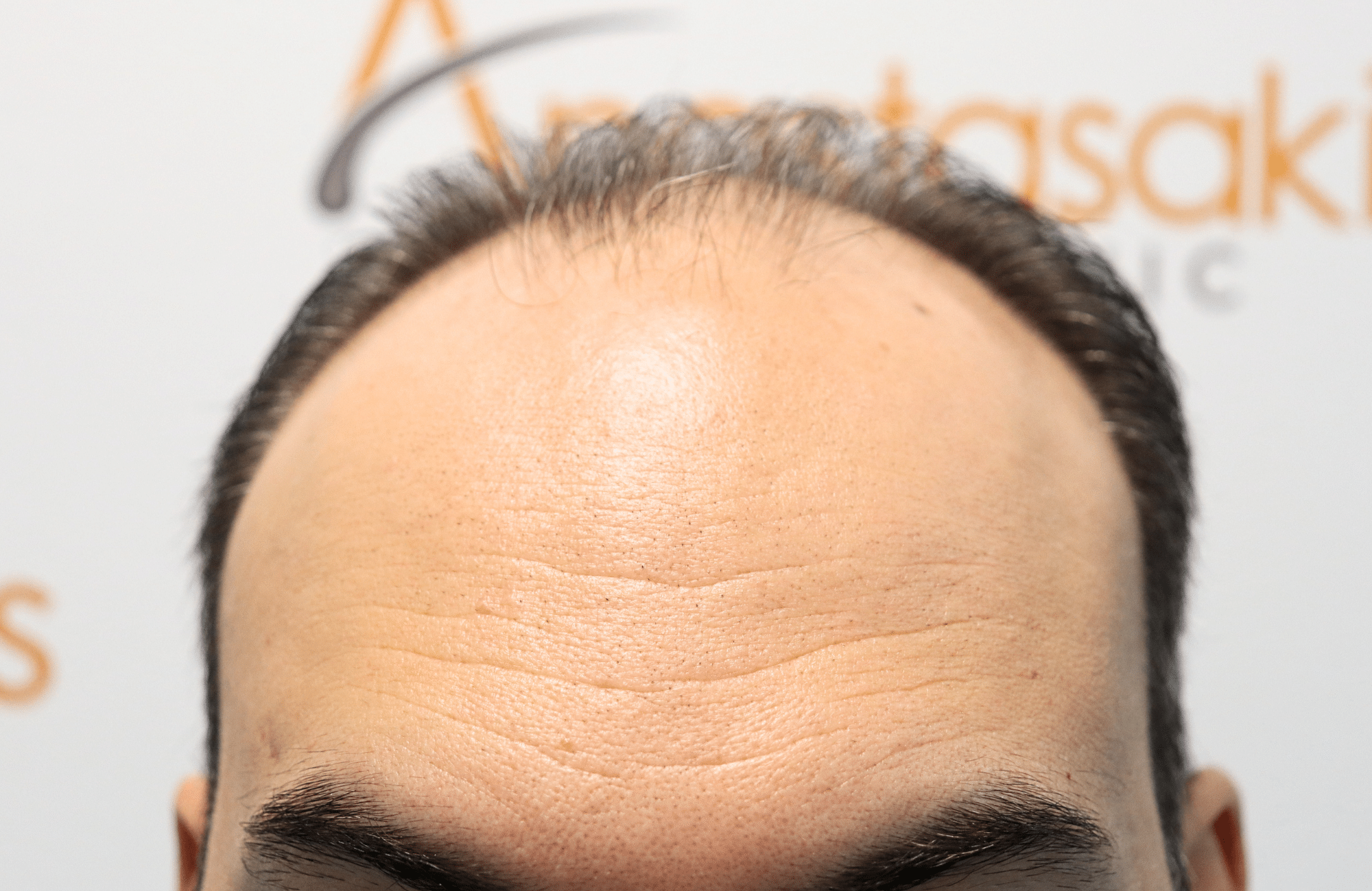 hair transplant result 3500 fus stage 6