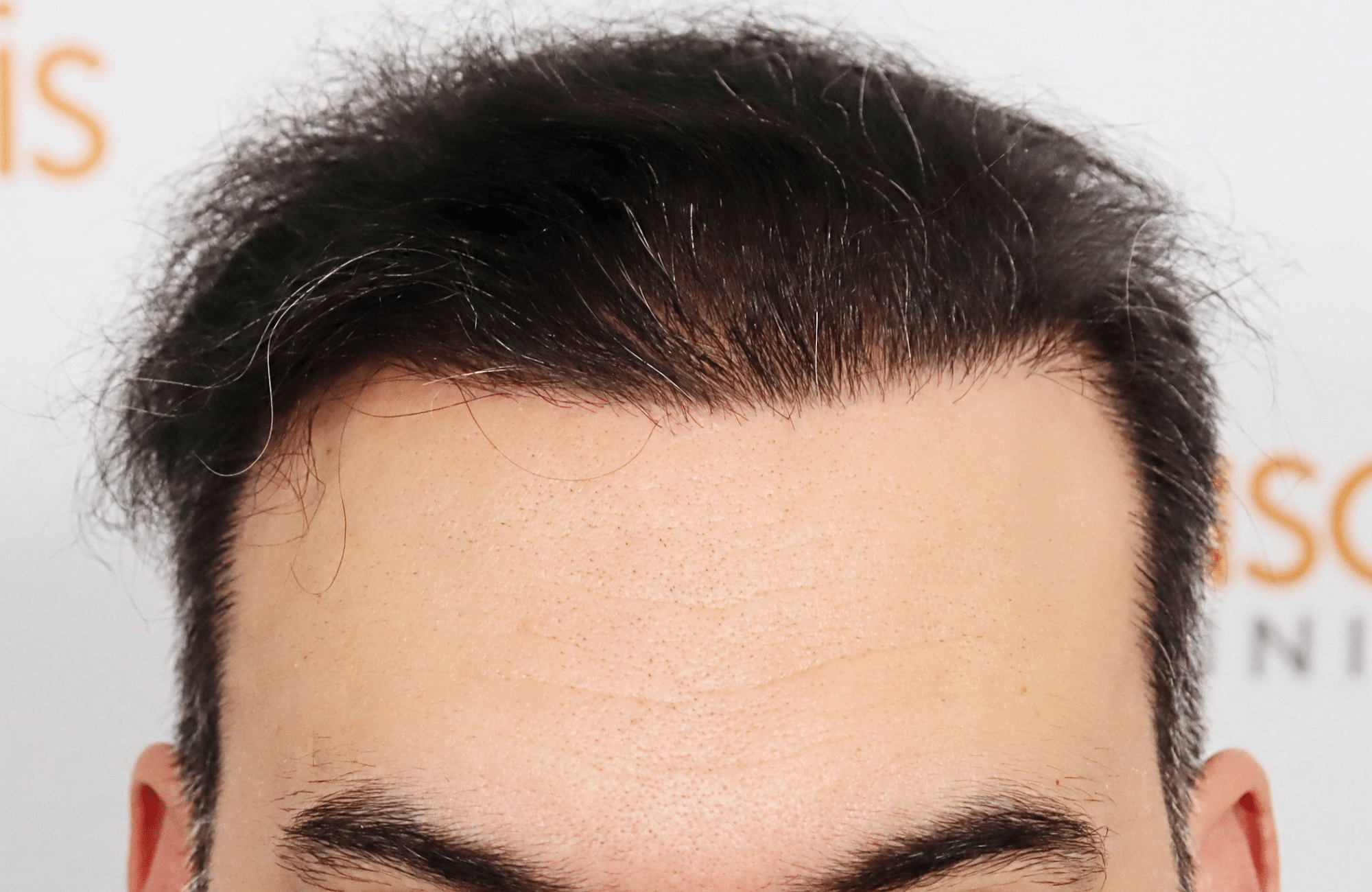 hair transplant result 3500 fus stage 6