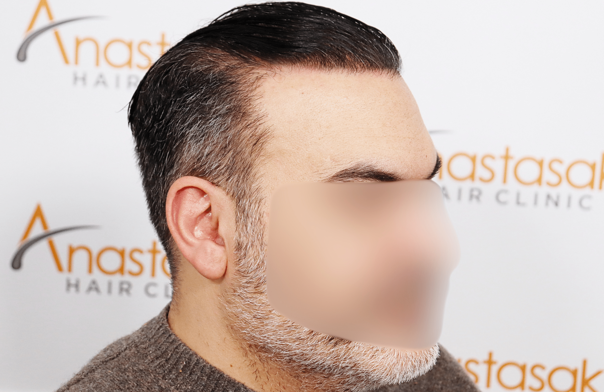 hair transplant result 3500 fus stage 6