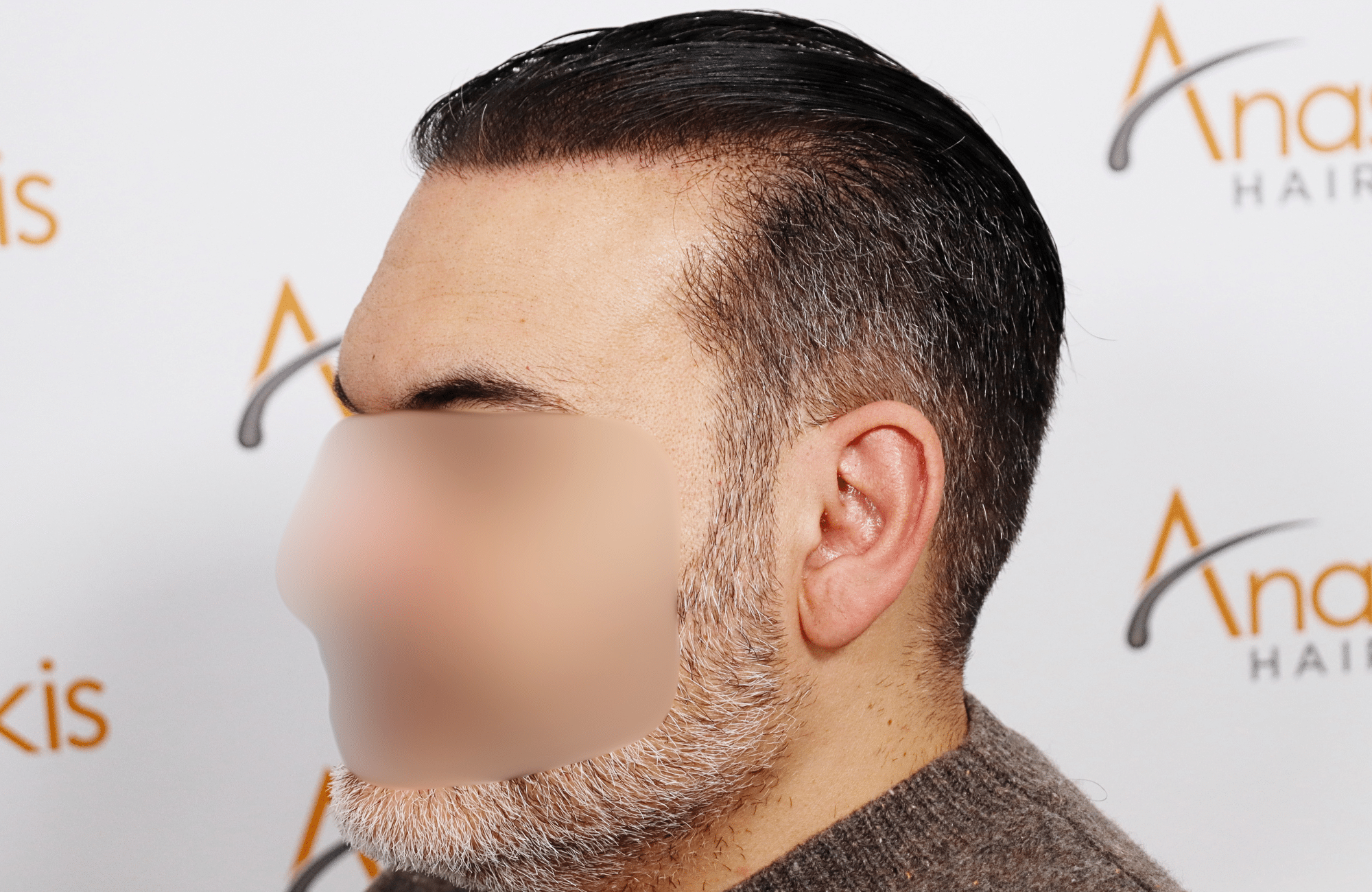 hair transplant result 3500 fus stage 6