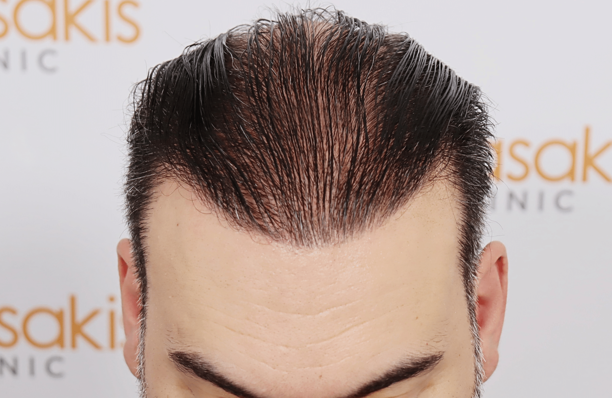 hair transplant result 3500 fus stage 6