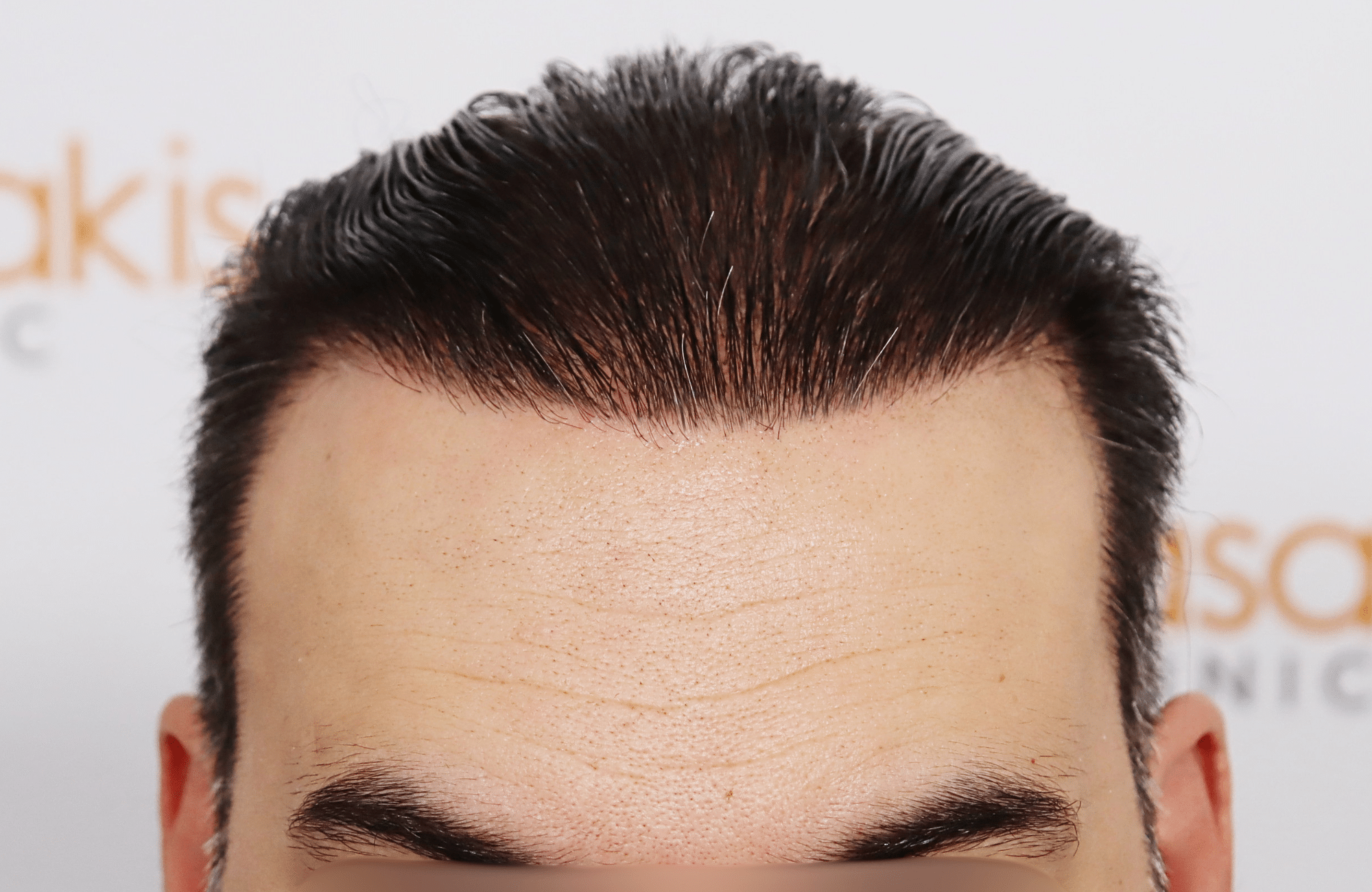 hair transplant result 3500 fus stage 6