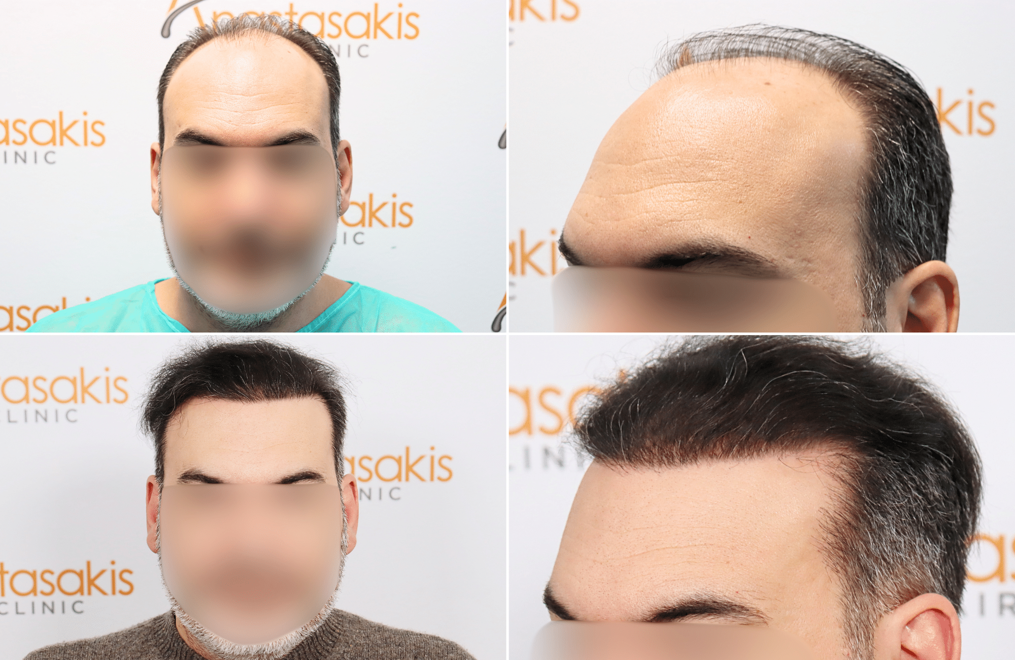https://www.anastasakishairclinic.gr/portfolio/apotelesma-metamosxefsis-mallion-anastasakis-hair-clinic-143/