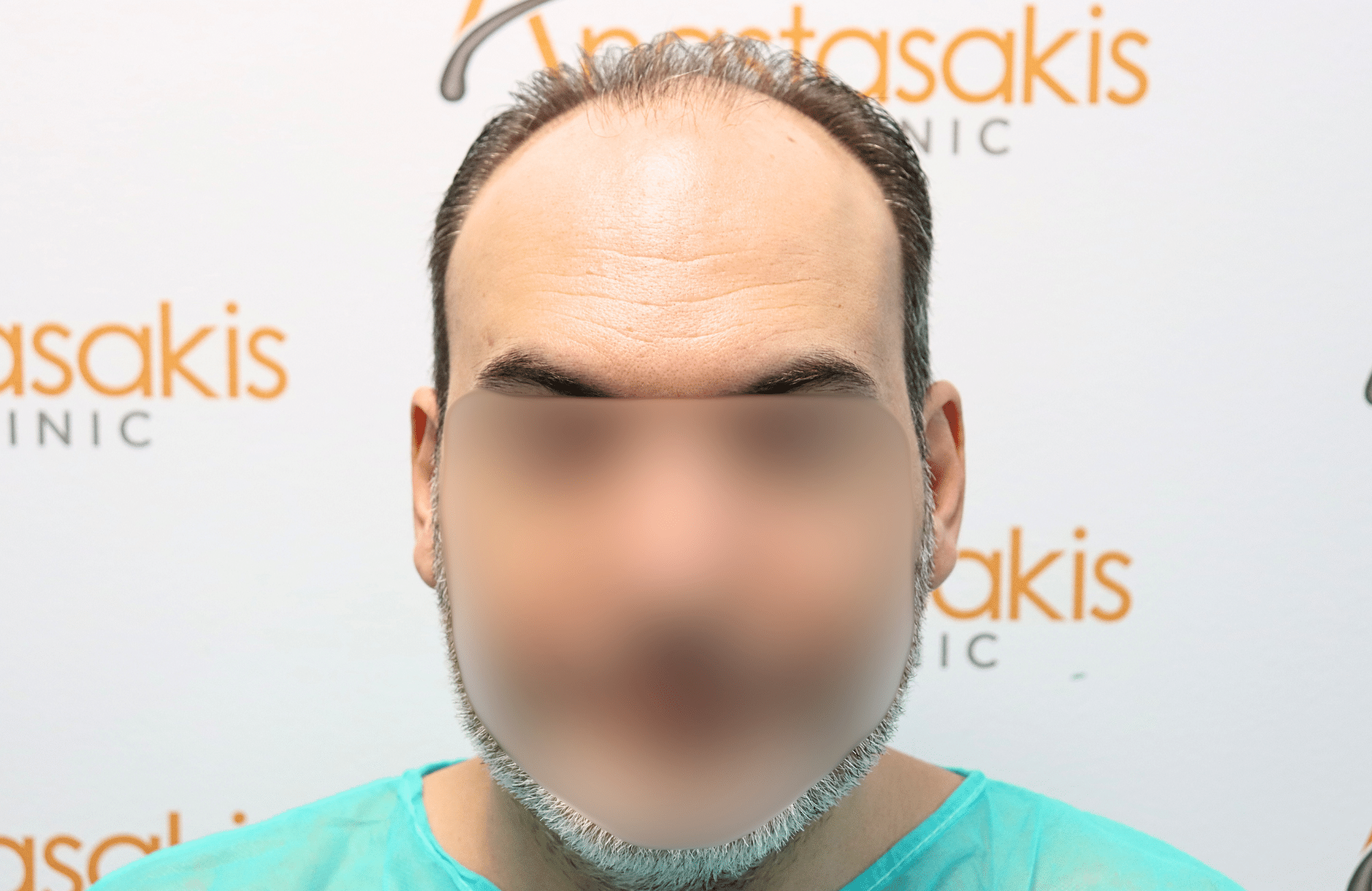 hair transplant result 3500 fus stage 6
