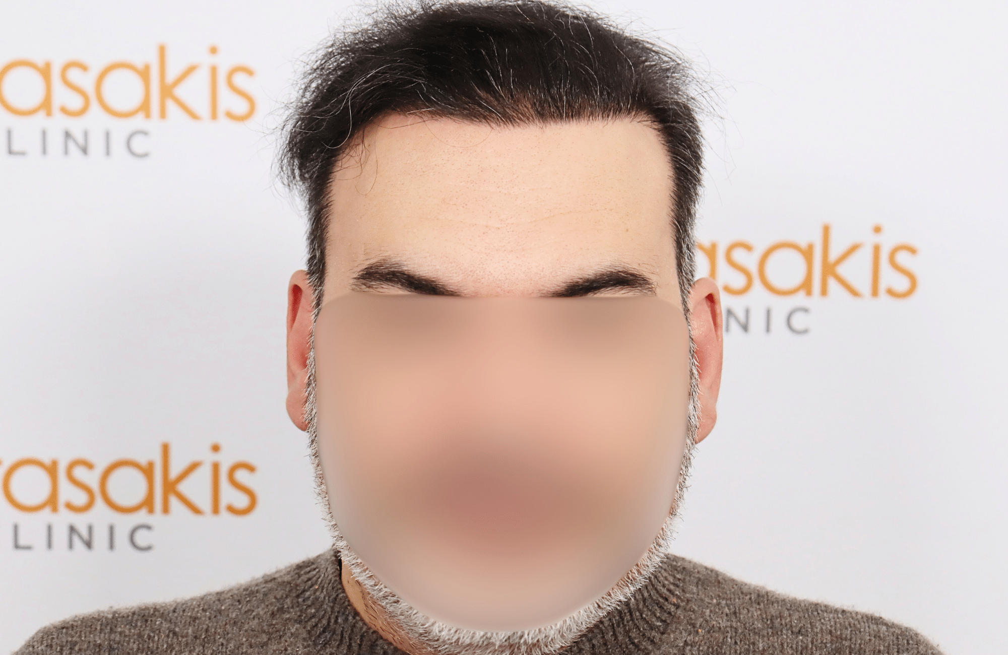 hair transplant result 3500 fus stage 6