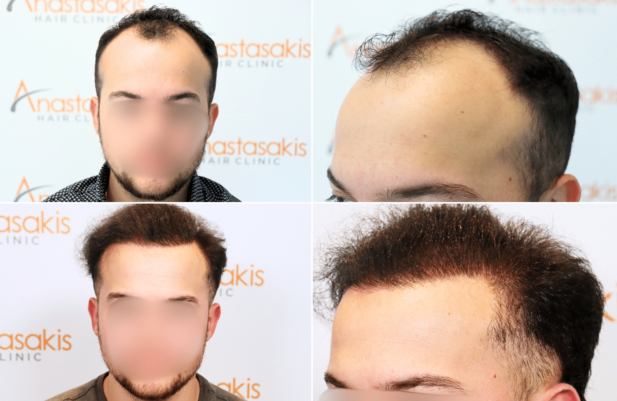https://www.anastasakishairclinic.gr/portfolio/apotelesma-metamosxefsis-mallion-anastasakis-hair-clinic-150/