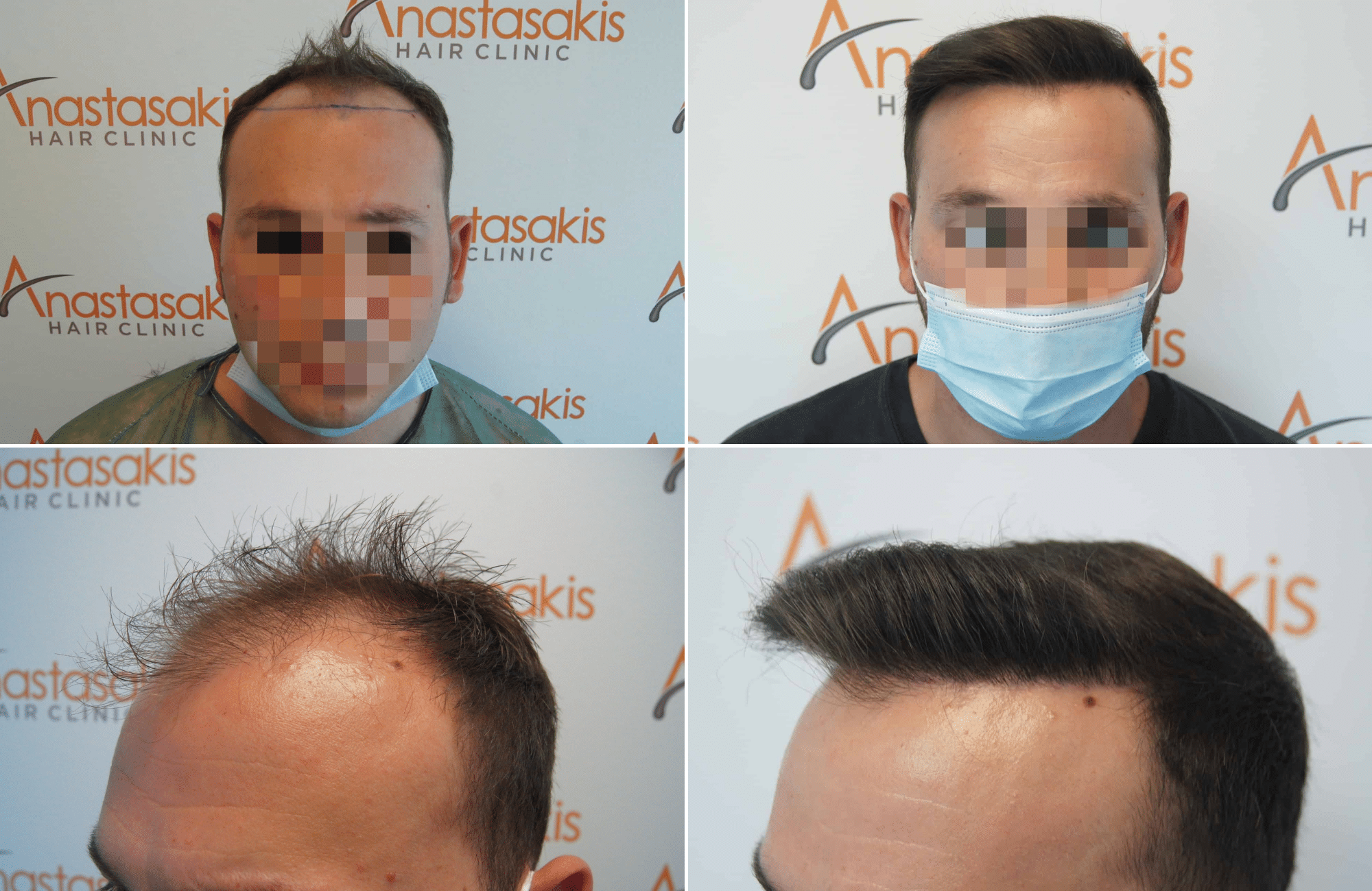 https://www.anastasakishairclinic.gr/portfolio/apotelesma-metamosxefsis-mallion-anastasakis-hair-clinic-332/