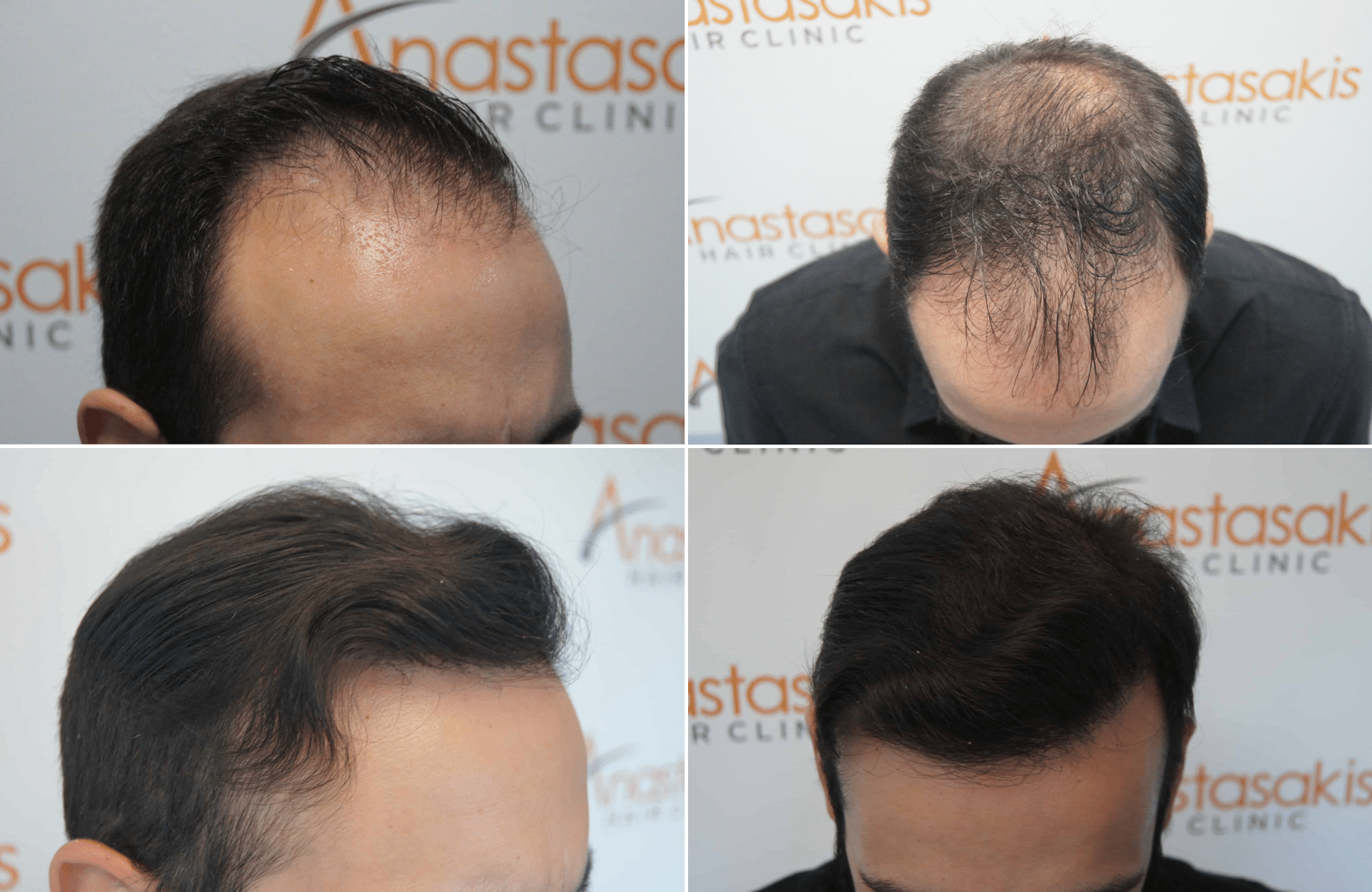 https://www.anastasakishairclinic.gr/portfolio/apotelesma-metamosxefsis-mallion-anastasakis-hair-clinic-331/