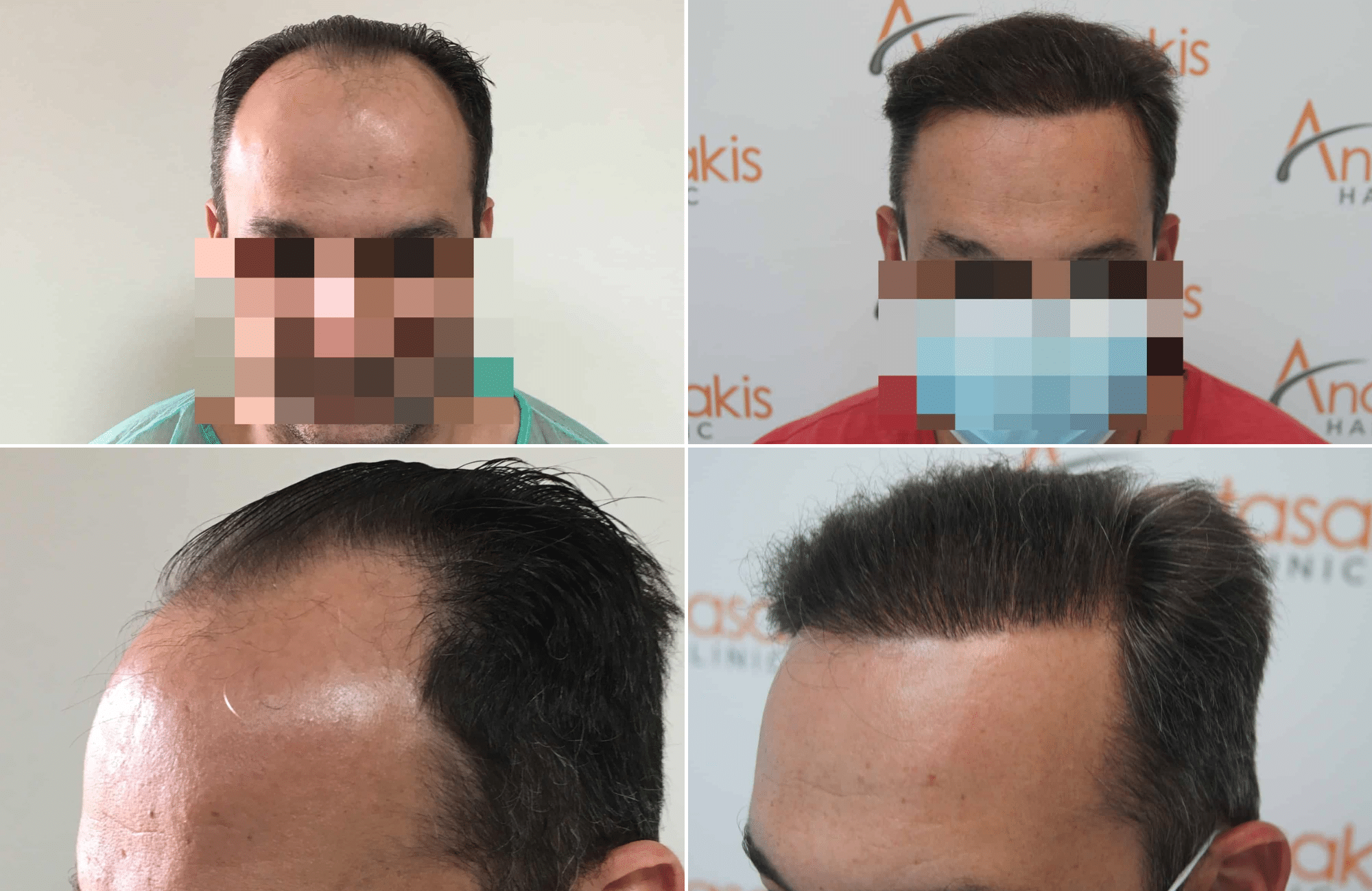 https://www.anastasakishairclinic.gr/portfolio/apotelesma-metamosxefsis-mallion-anastasakis-hair-clinic-319/