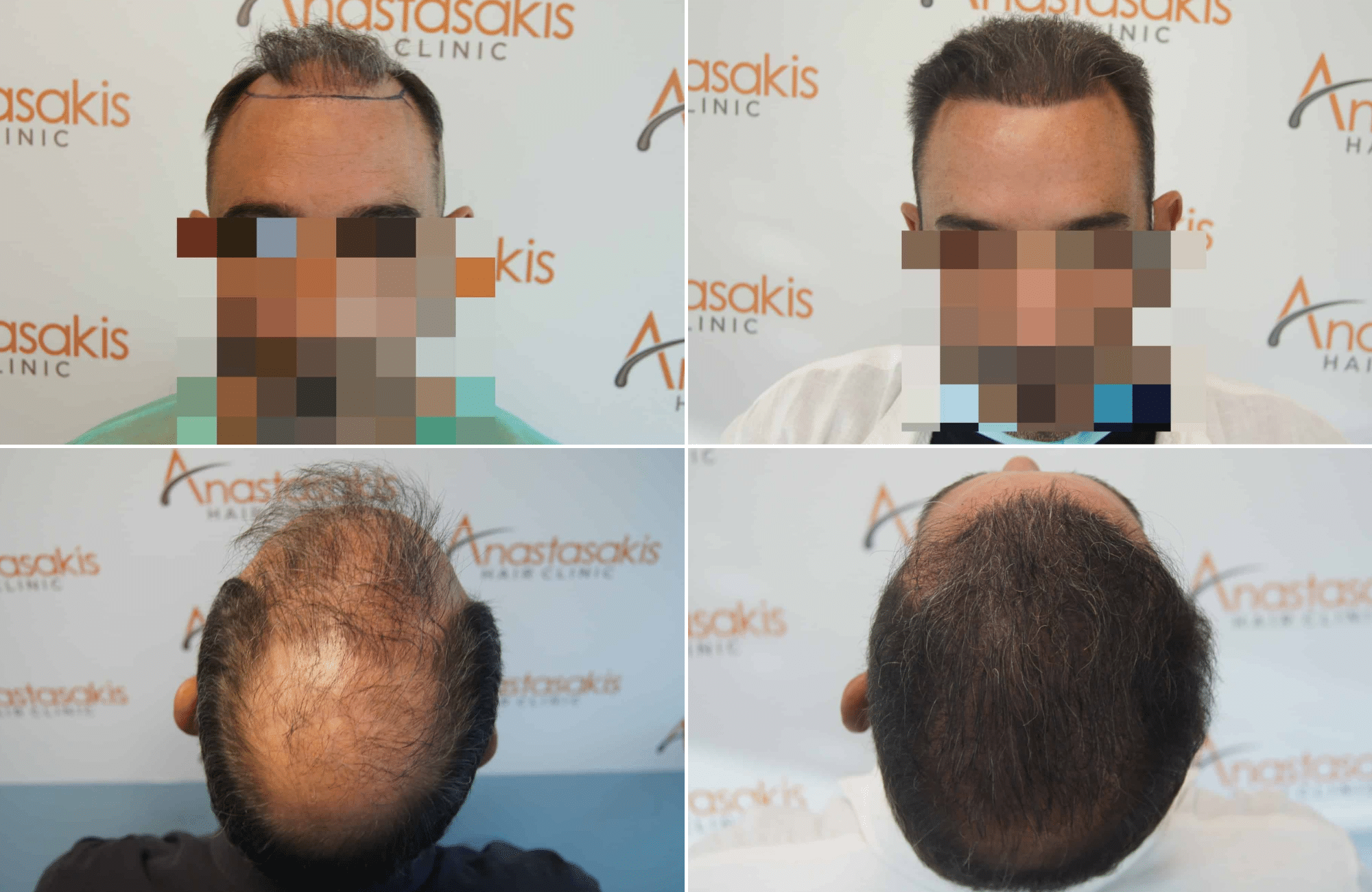 https://www.anastasakishairclinic.gr/portfolio/apotelesma-metamosxefsis-mallion-anastasakis-hair-clinic-320/