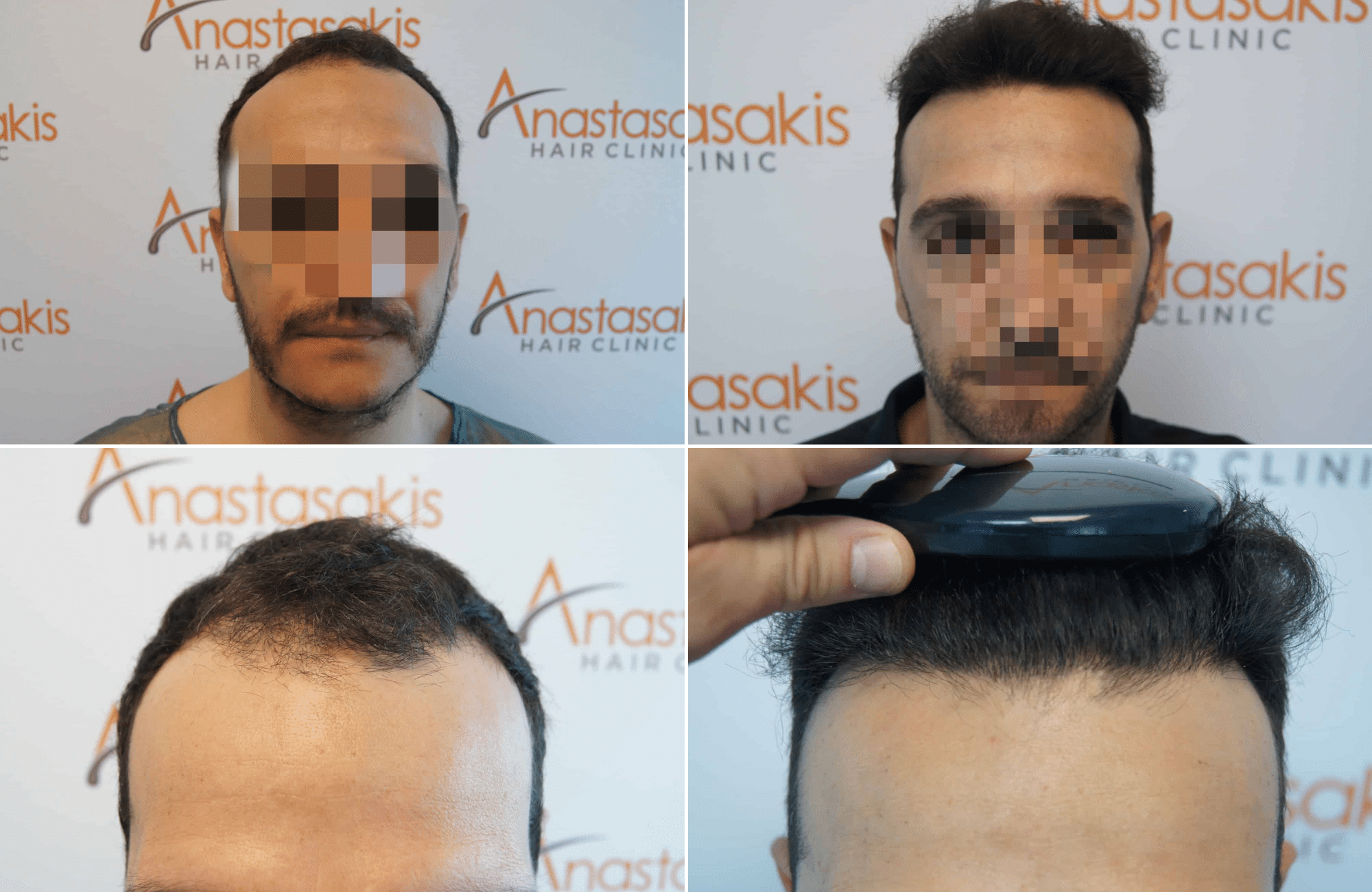 https://www.anastasakishairclinic.gr/portfolio/apotelesma-metamosxefsis-mallion-anastasakis-hair-clinic-321/