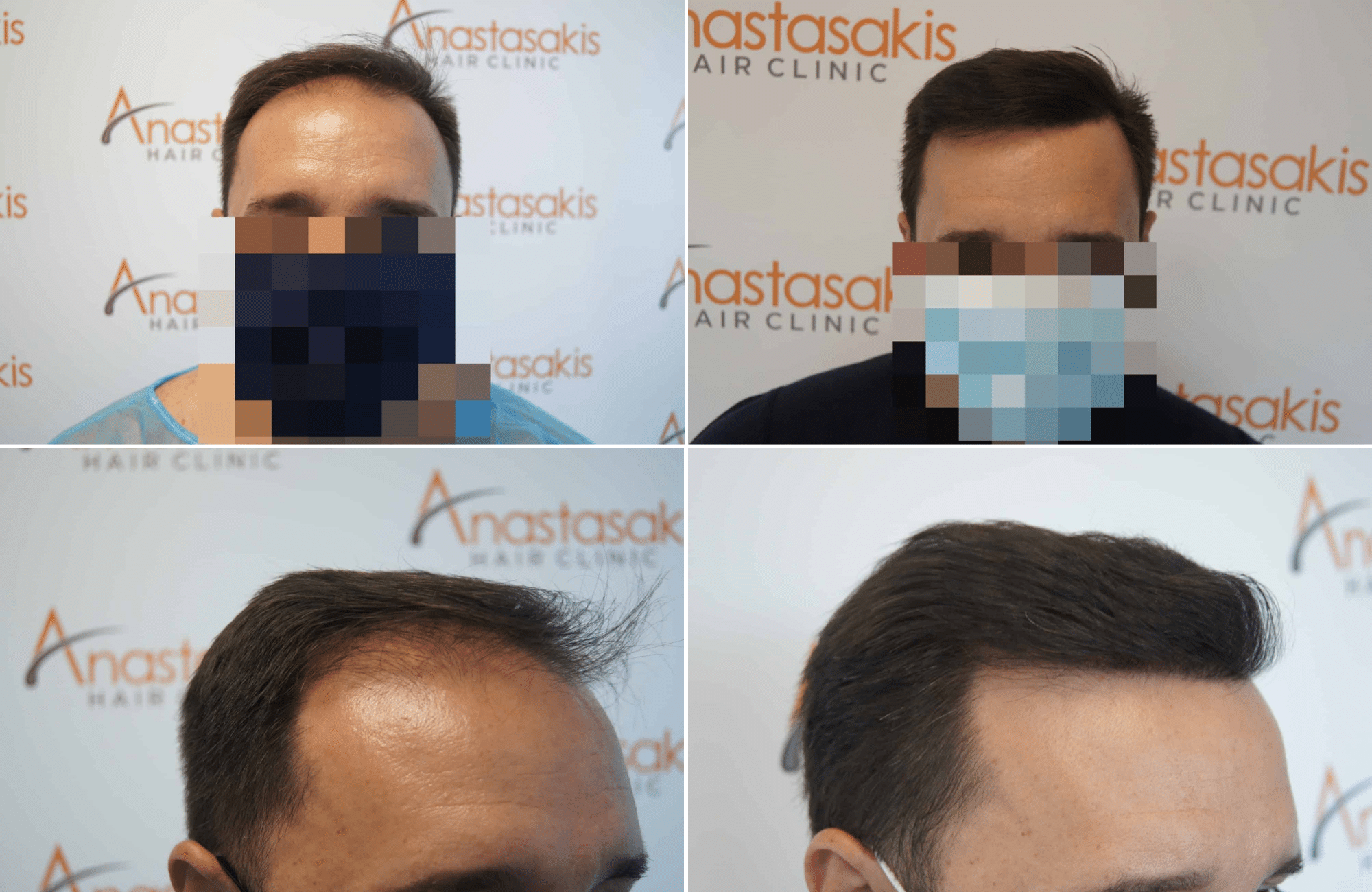 https://www.anastasakishairclinic.gr/portfolio/apotelesma-metamosxefsis-mallion-anastasakis-hair-clinic-326/