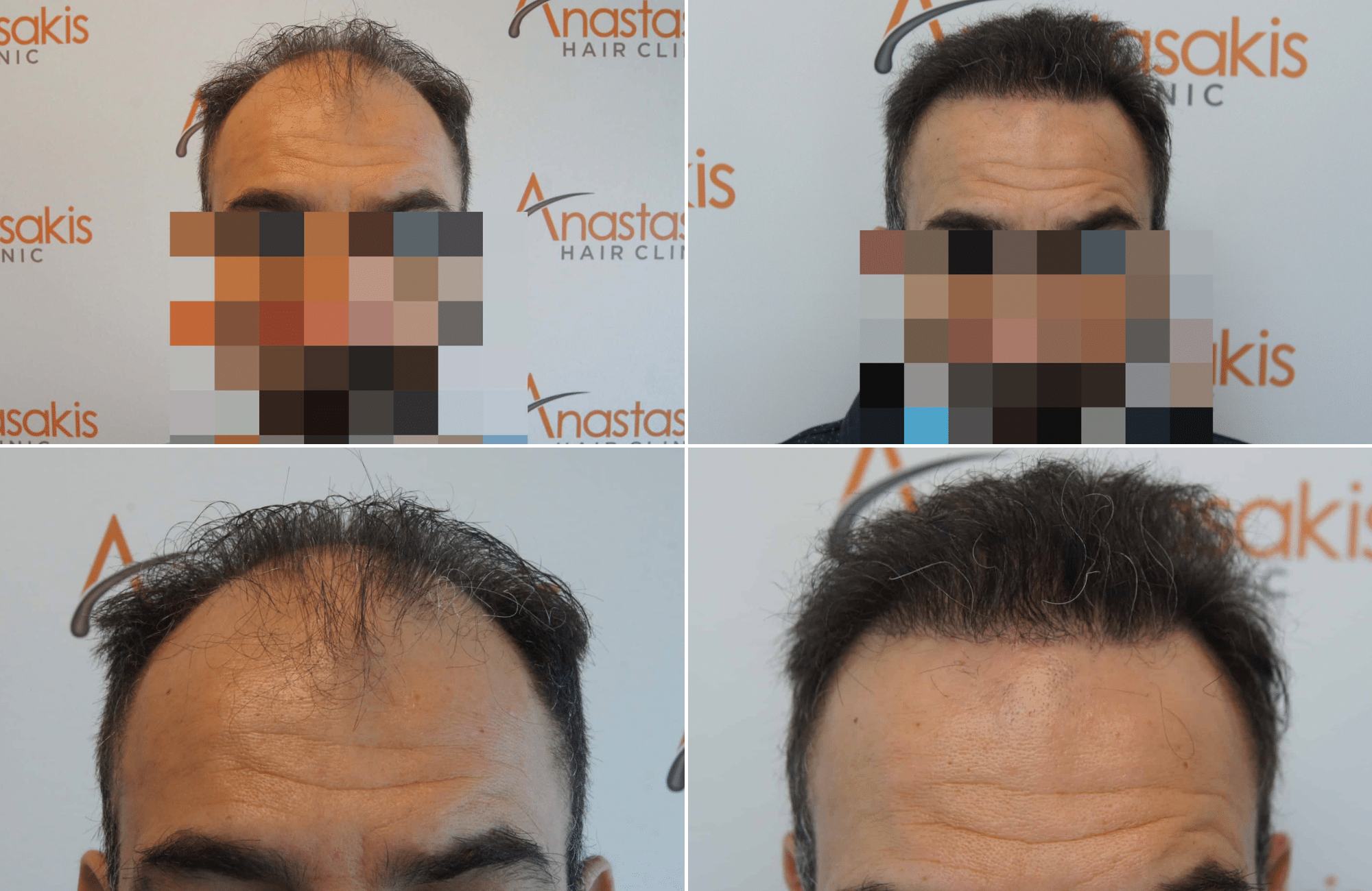 https://www.anastasakishairclinic.gr/portfolio/apotelesma-metamosxefsis-mallion-anastasakis-hair-clinic-328/