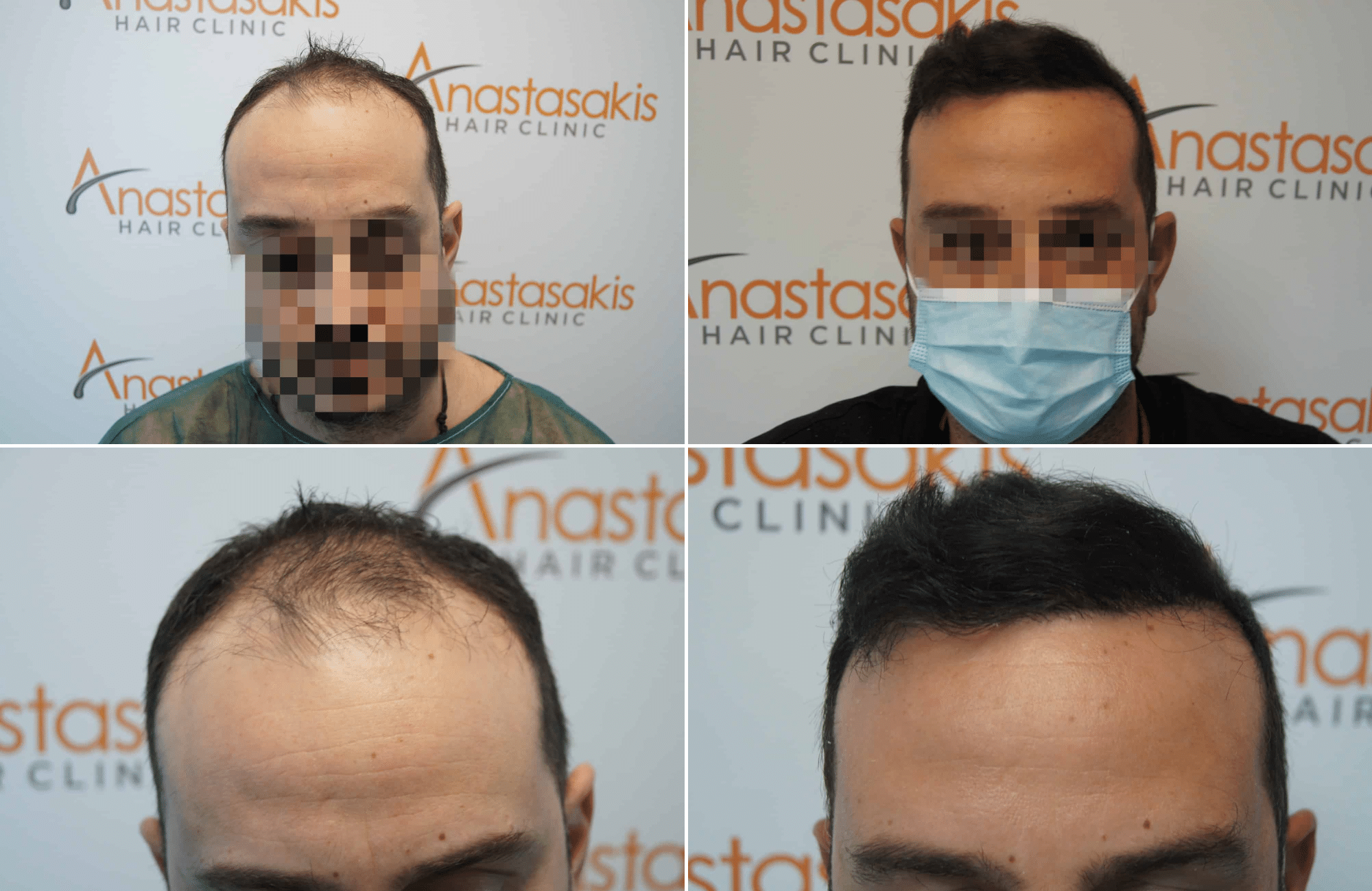 https://www.anastasakishairclinic.gr/portfolio/apotelesma-metamosxefsis-mallion-anastasakis-hair-clinic-338/