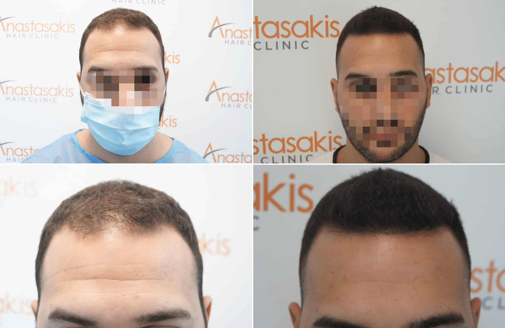 https://www.anastasakishairclinic.gr/portfolio/apotelesma-metamosxefsis-mallion-anastasakis-hair-clinic-339/