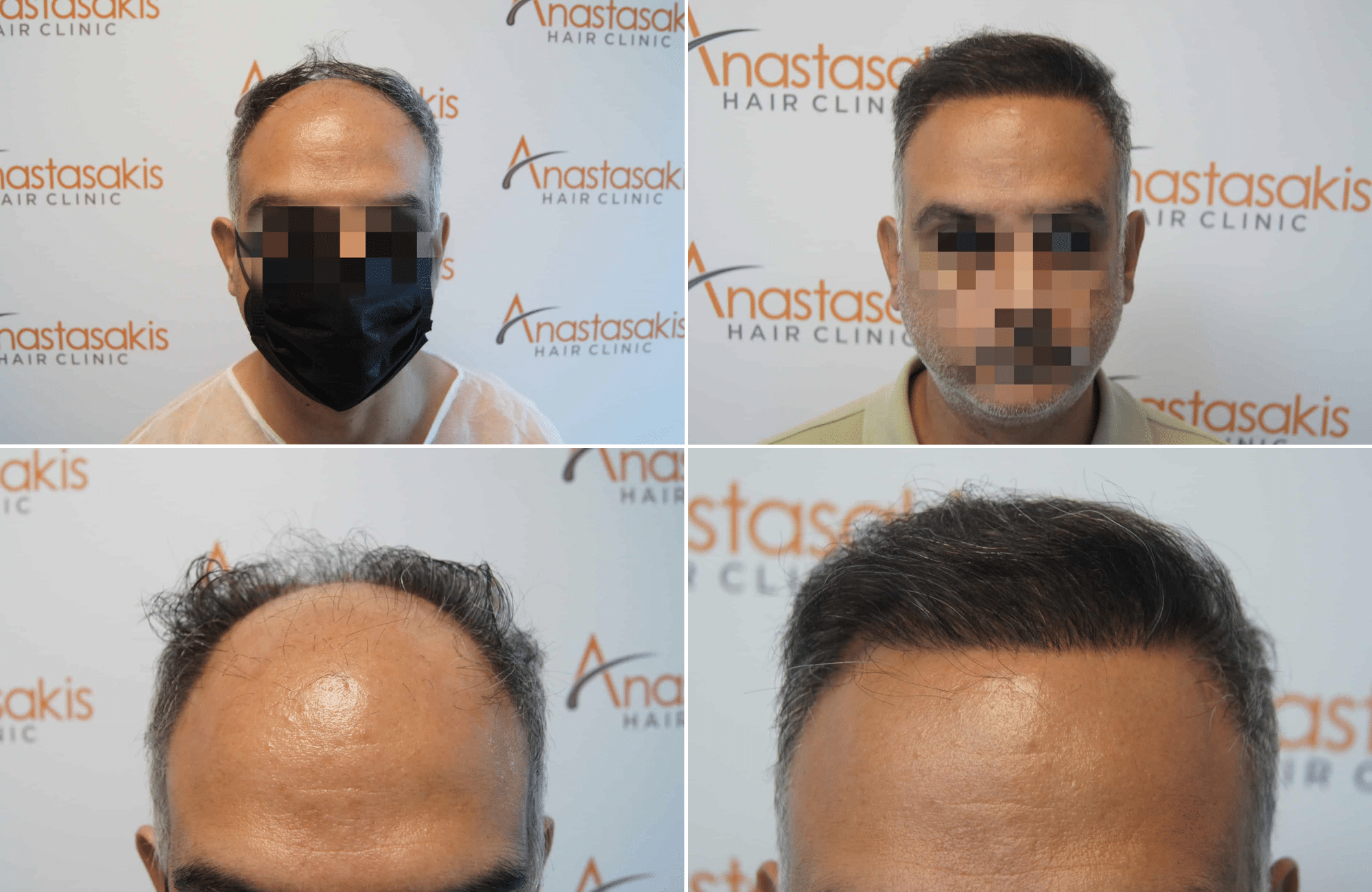 https://www.anastasakishairclinic.gr/portfolio/apotelesma-metamosxefsis-mallion-anastasakis-hair-clinic-334/