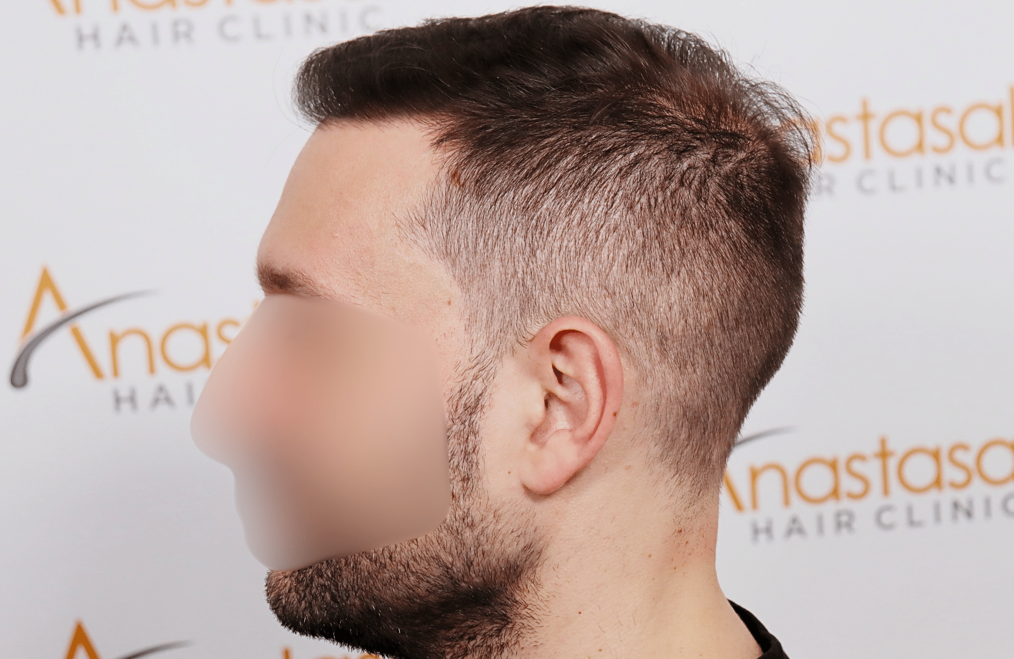 hair transplant 3500 fus stage 5 thin