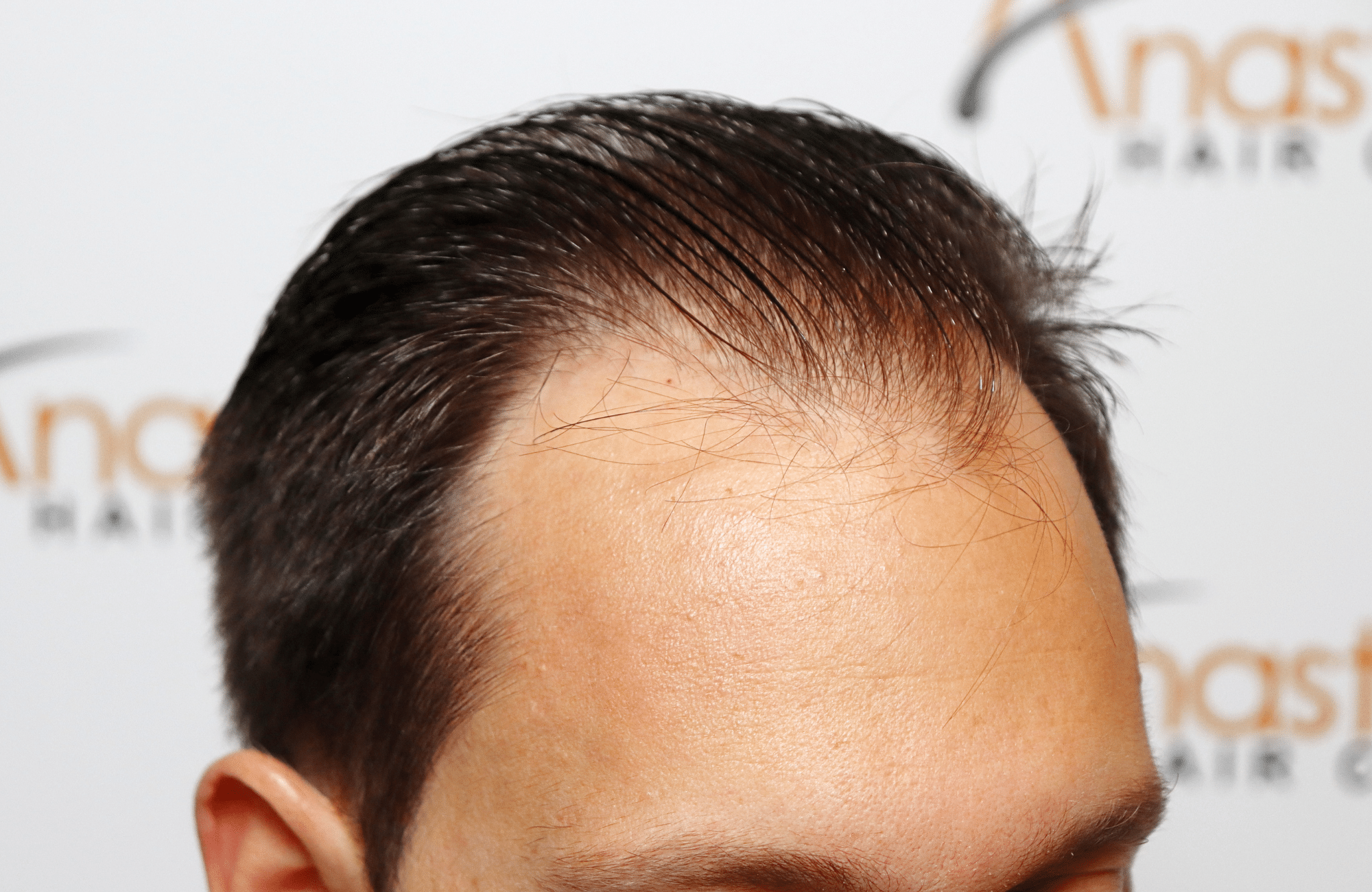 hair transplant 3500 fus stage 5 thin