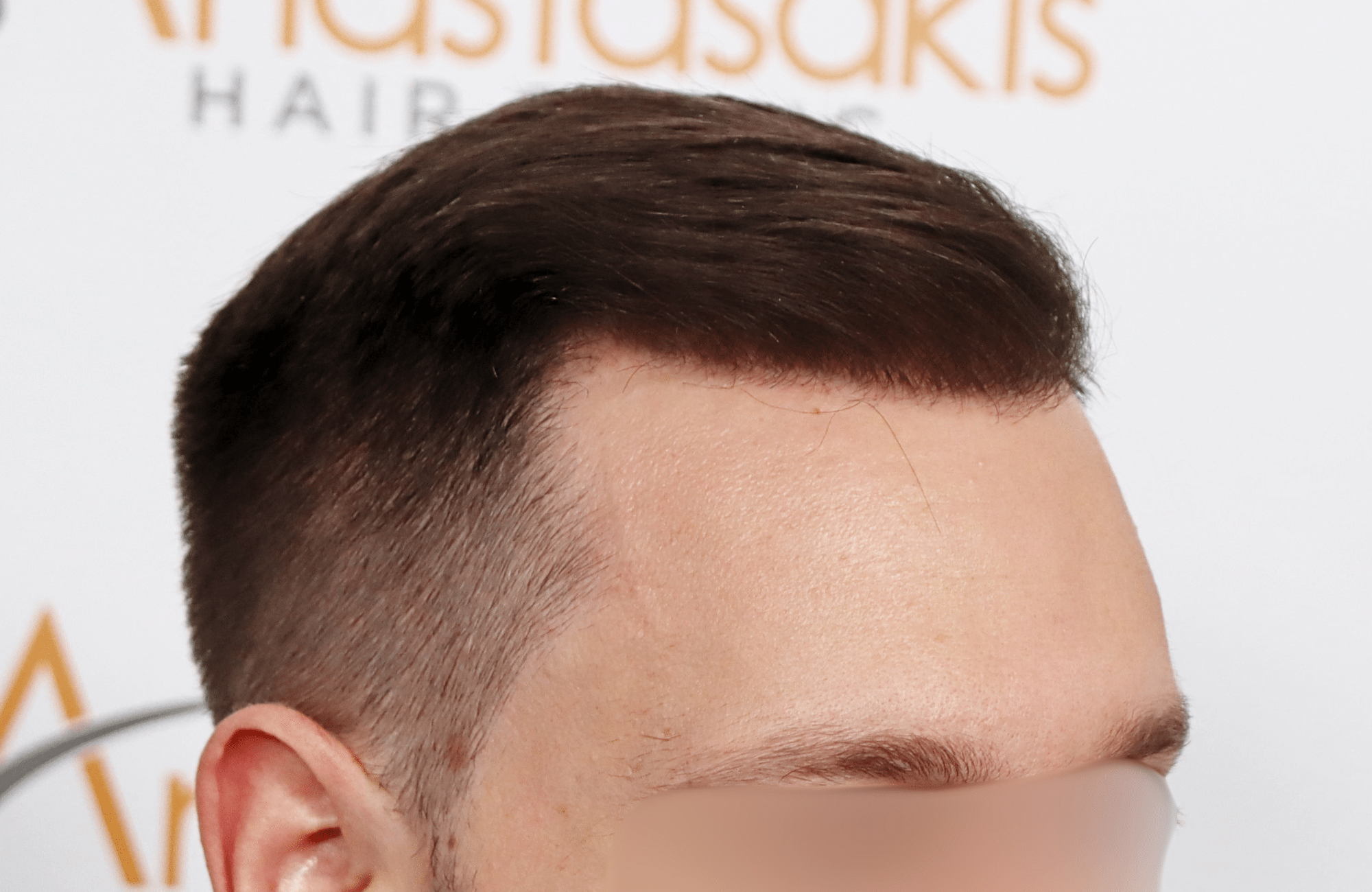 hair transplant 3500 fus stage 5 thin