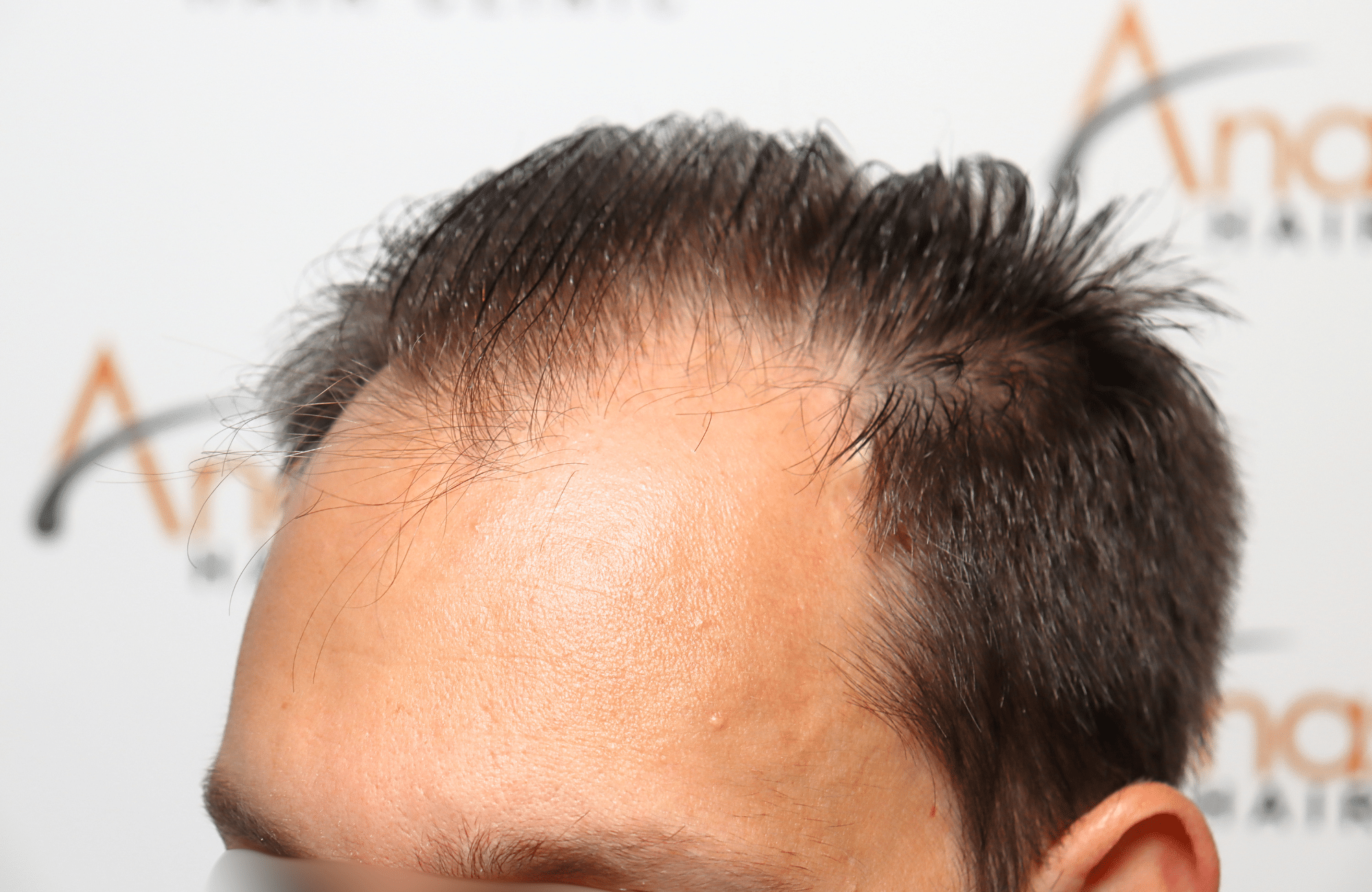 hair transplant 3500 fus stage 5 thin