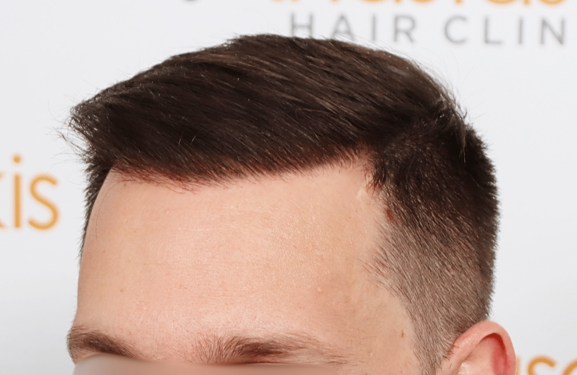 hair transplant 3500 fus stage 5 thin