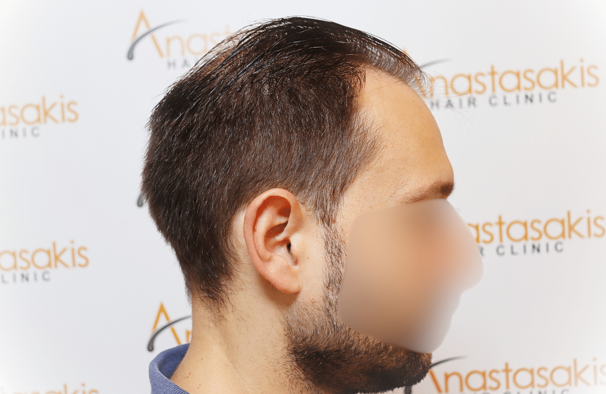 hair transplant 3500 fus stage 5 thin