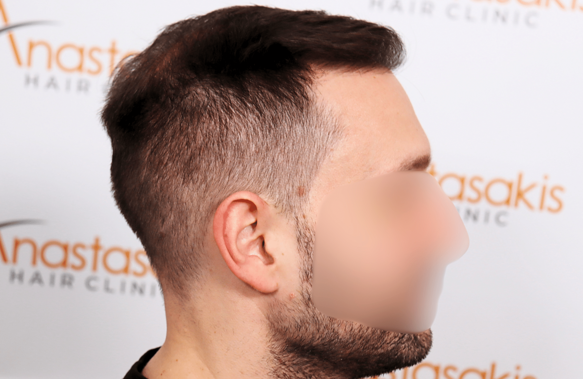 hair transplant 3500 fus stage 5 thin