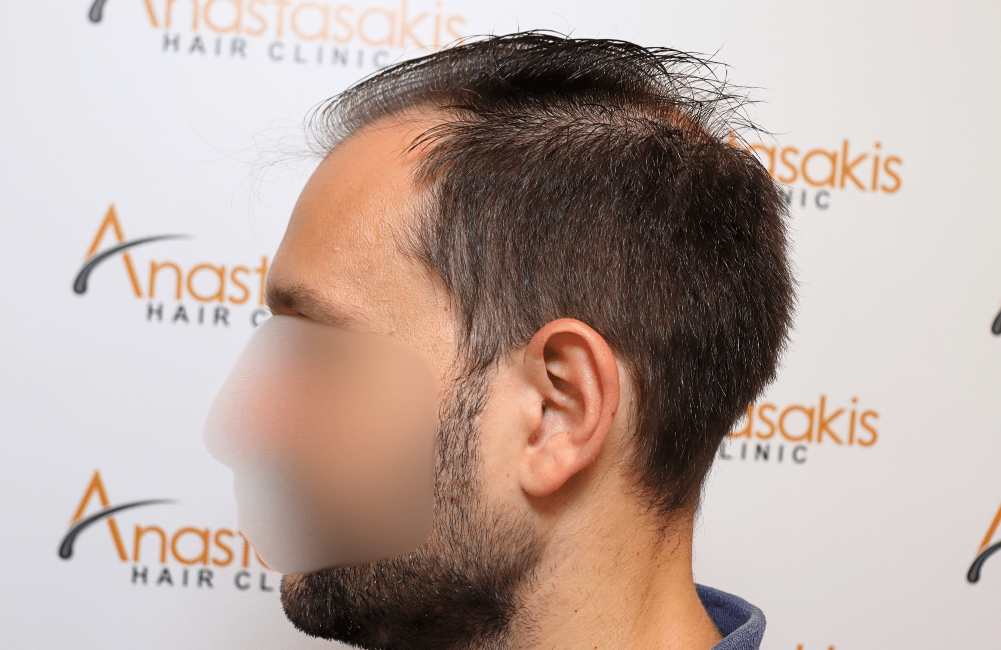 hair transplant 3500 fus stage 5 thin