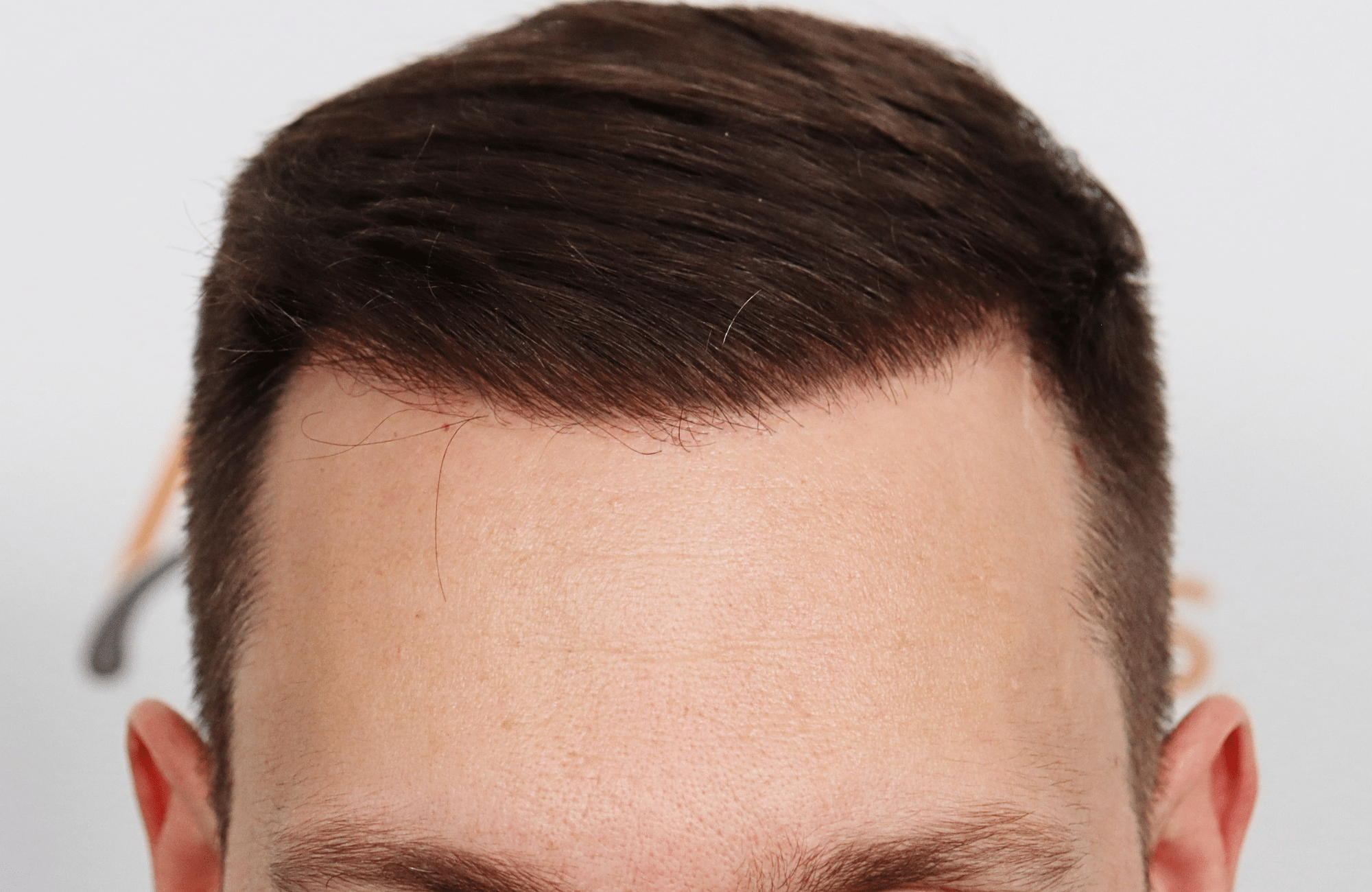 hair transplant 3500 fus stage 5 thin
