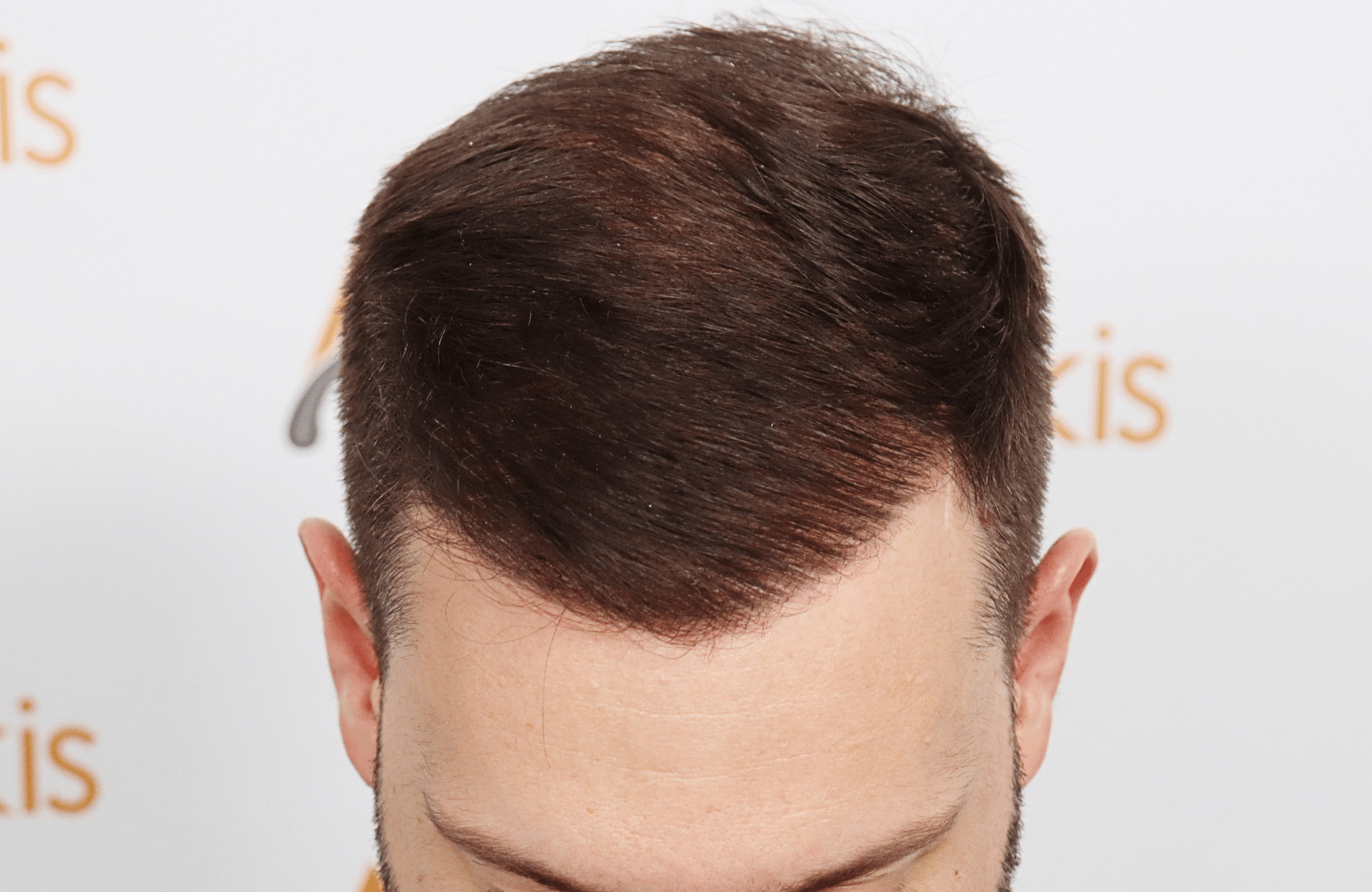 hair transplant 3500 fus stage 5 thin