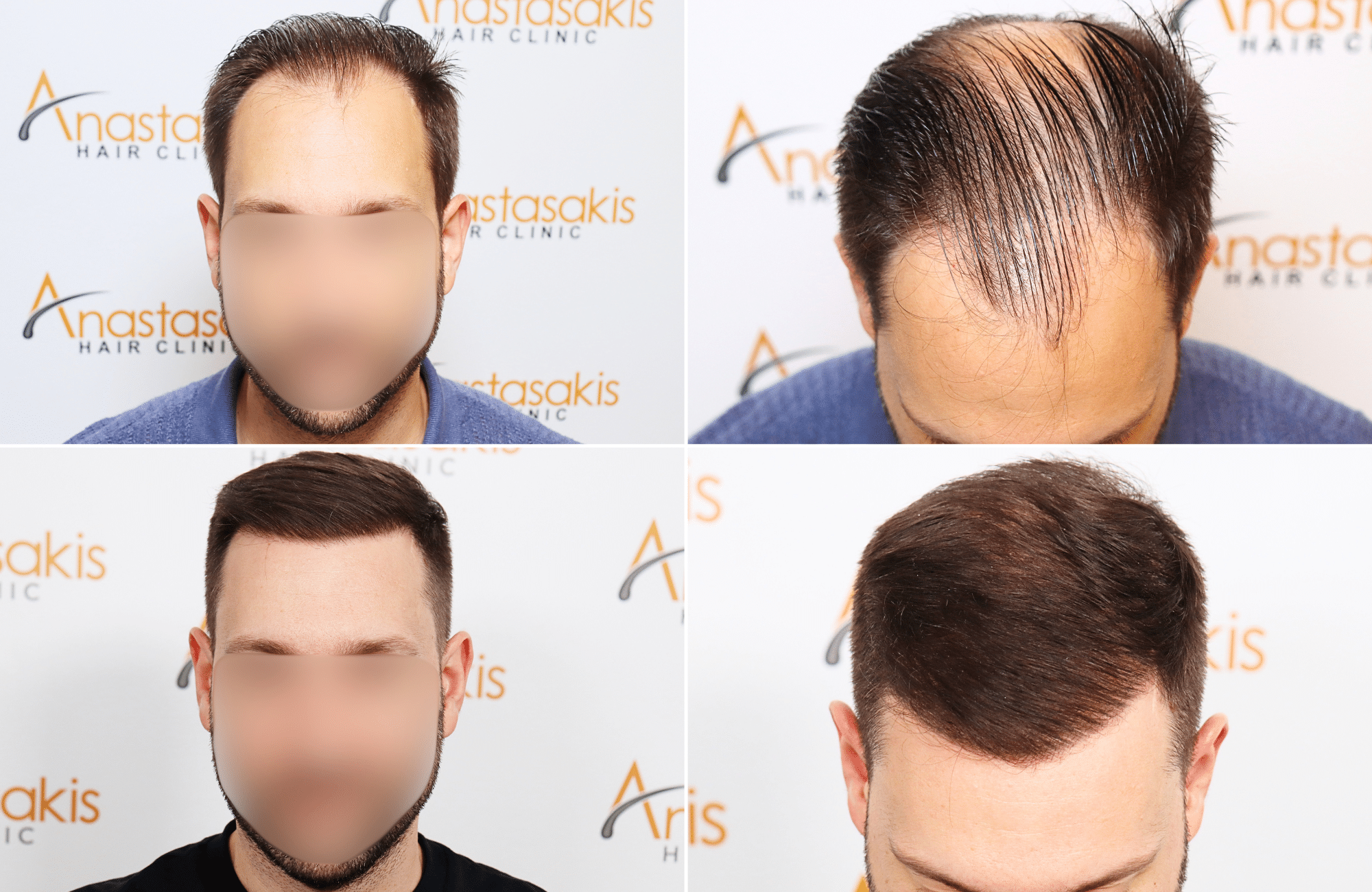 https://www.anastasakishairclinic.gr/portfolio/apotelesma-metamosxefsis-mallion-anastasakis-hair-clinic-604/