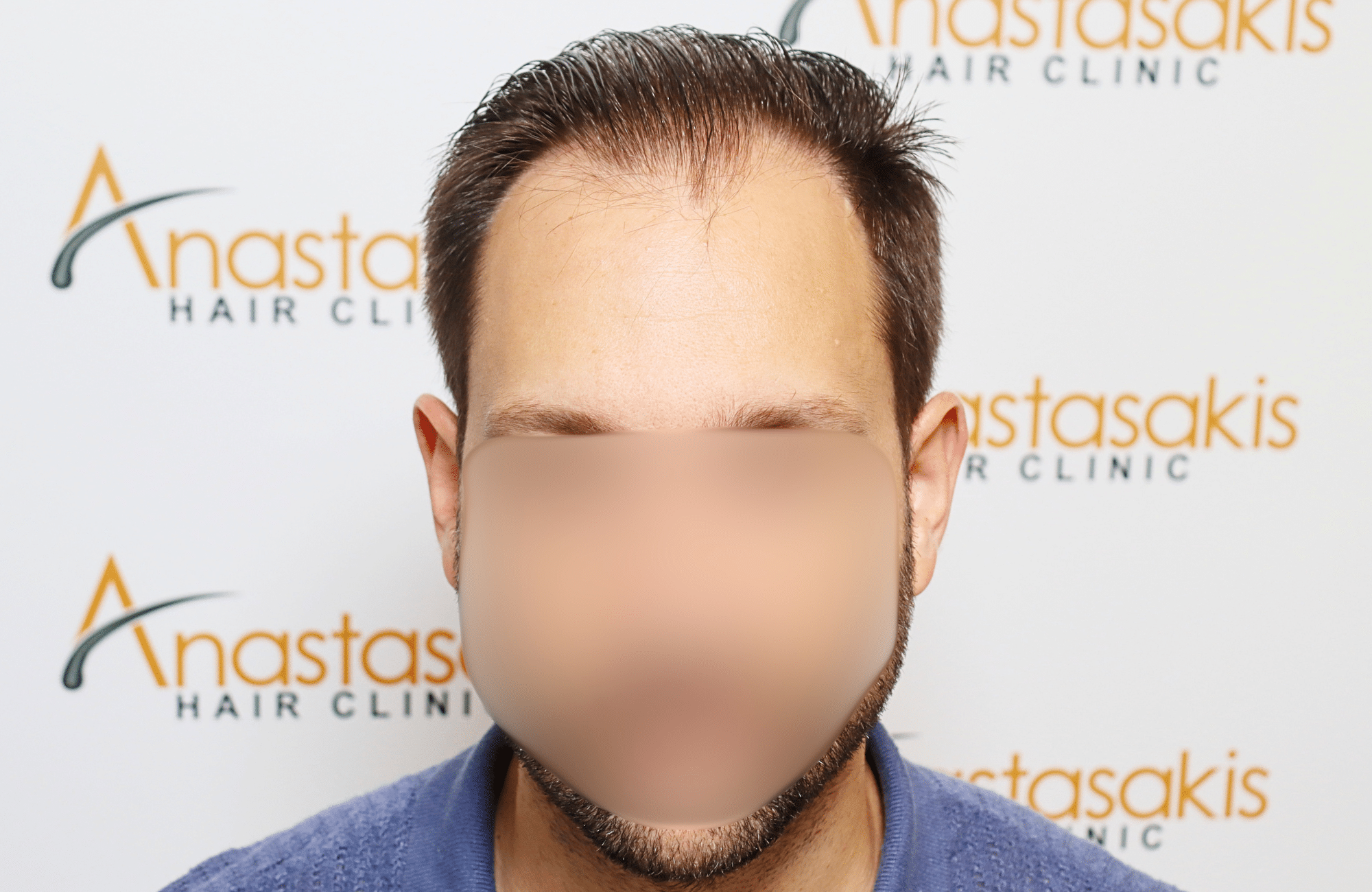 hair transplant 3500 fus stage 5 thin