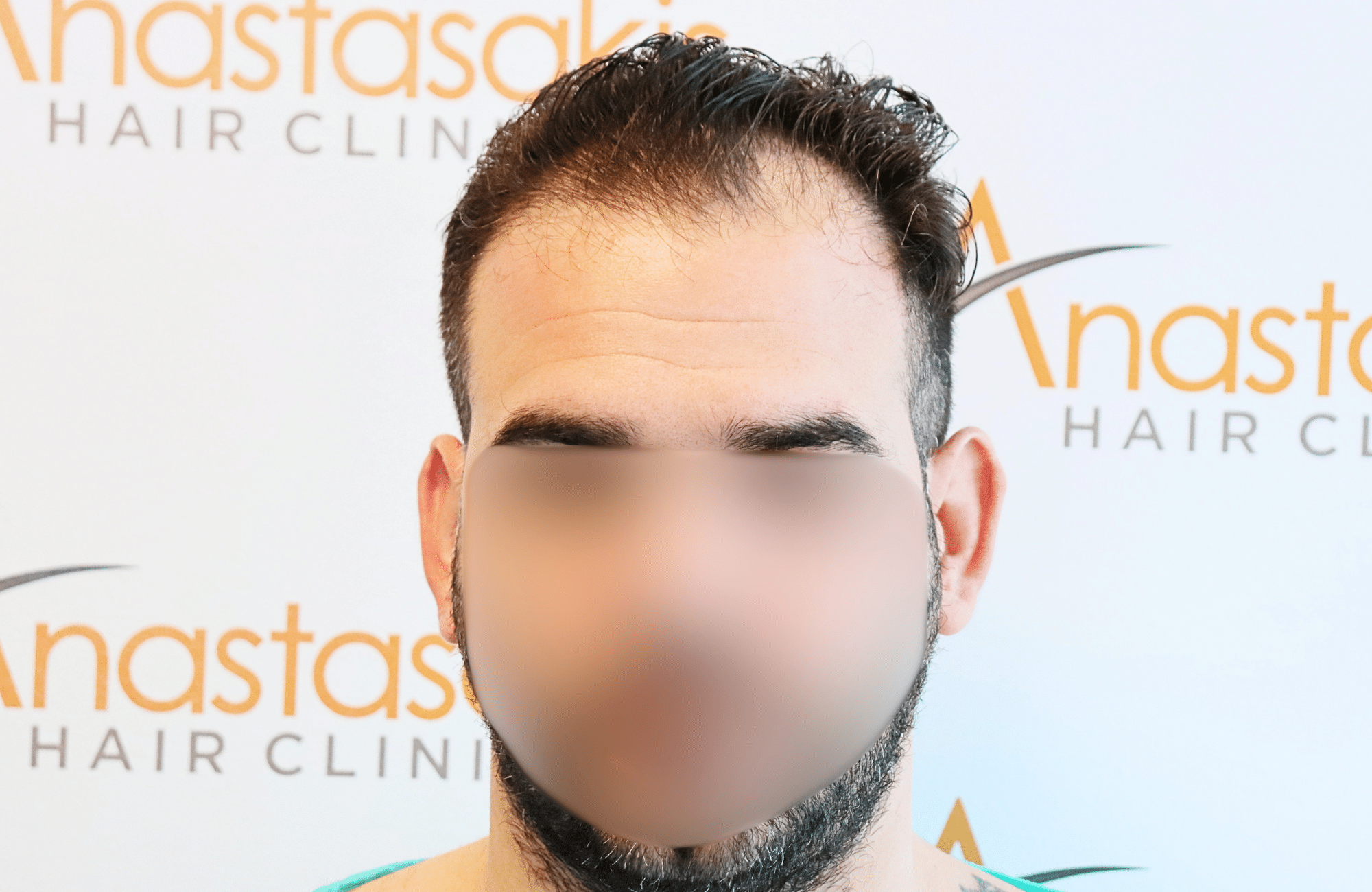 hair transplant result 2300 fus thick frontal