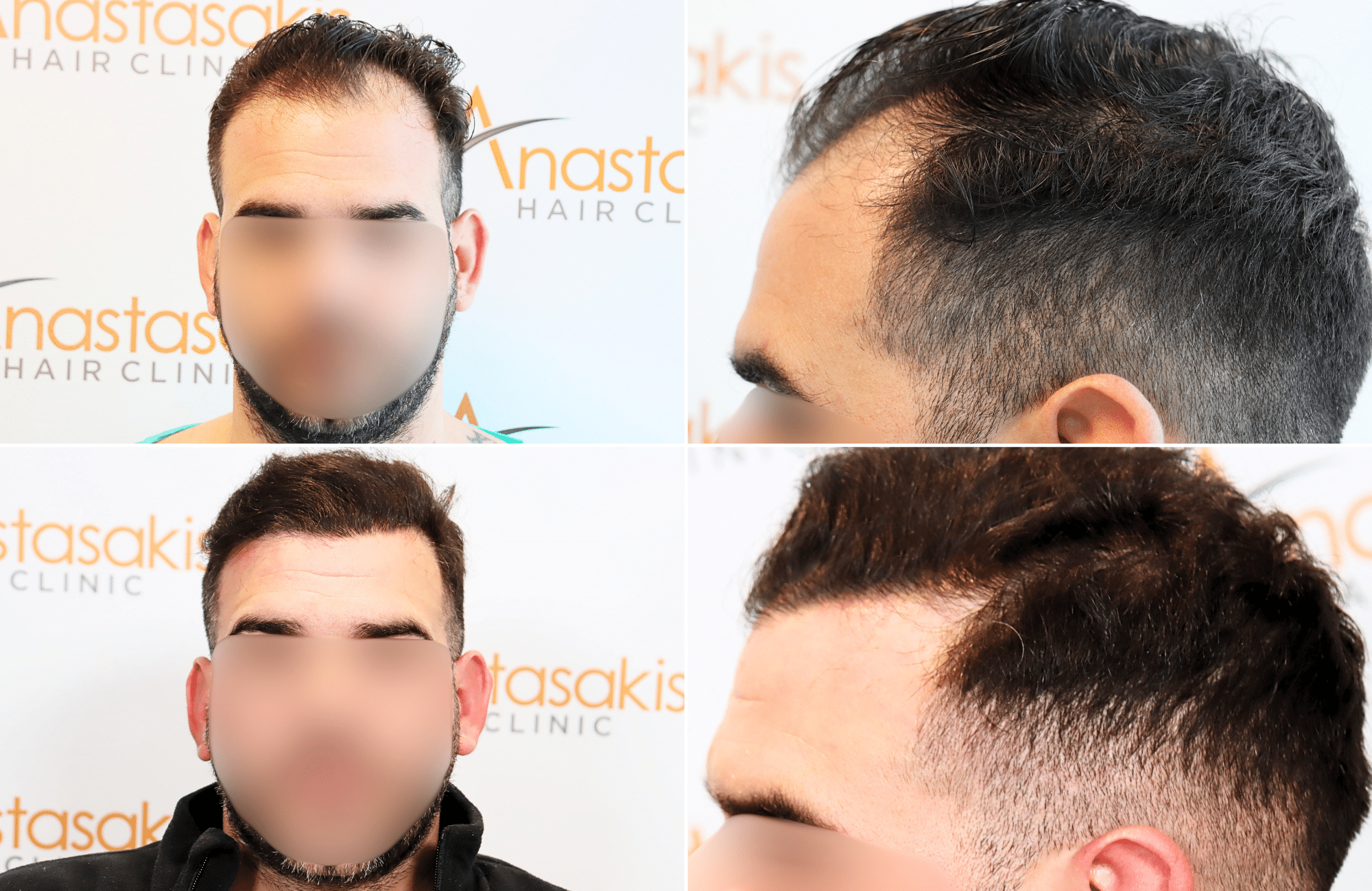 https://www.anastasakishairclinic.gr/portfolio/apotelesma-metamosxefsis-mallion-anastasakis-hair-clinic-113/