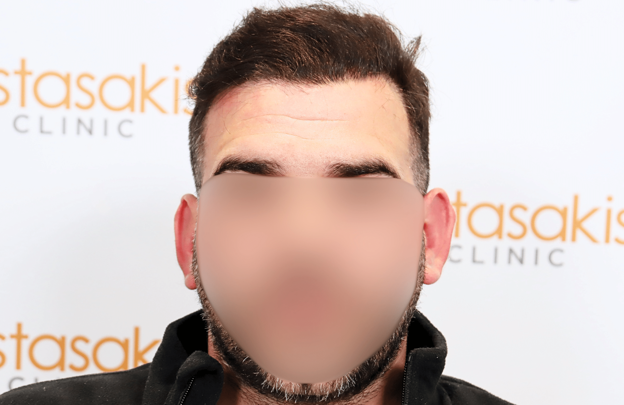 hair transplant result 2300 fus thick frontal