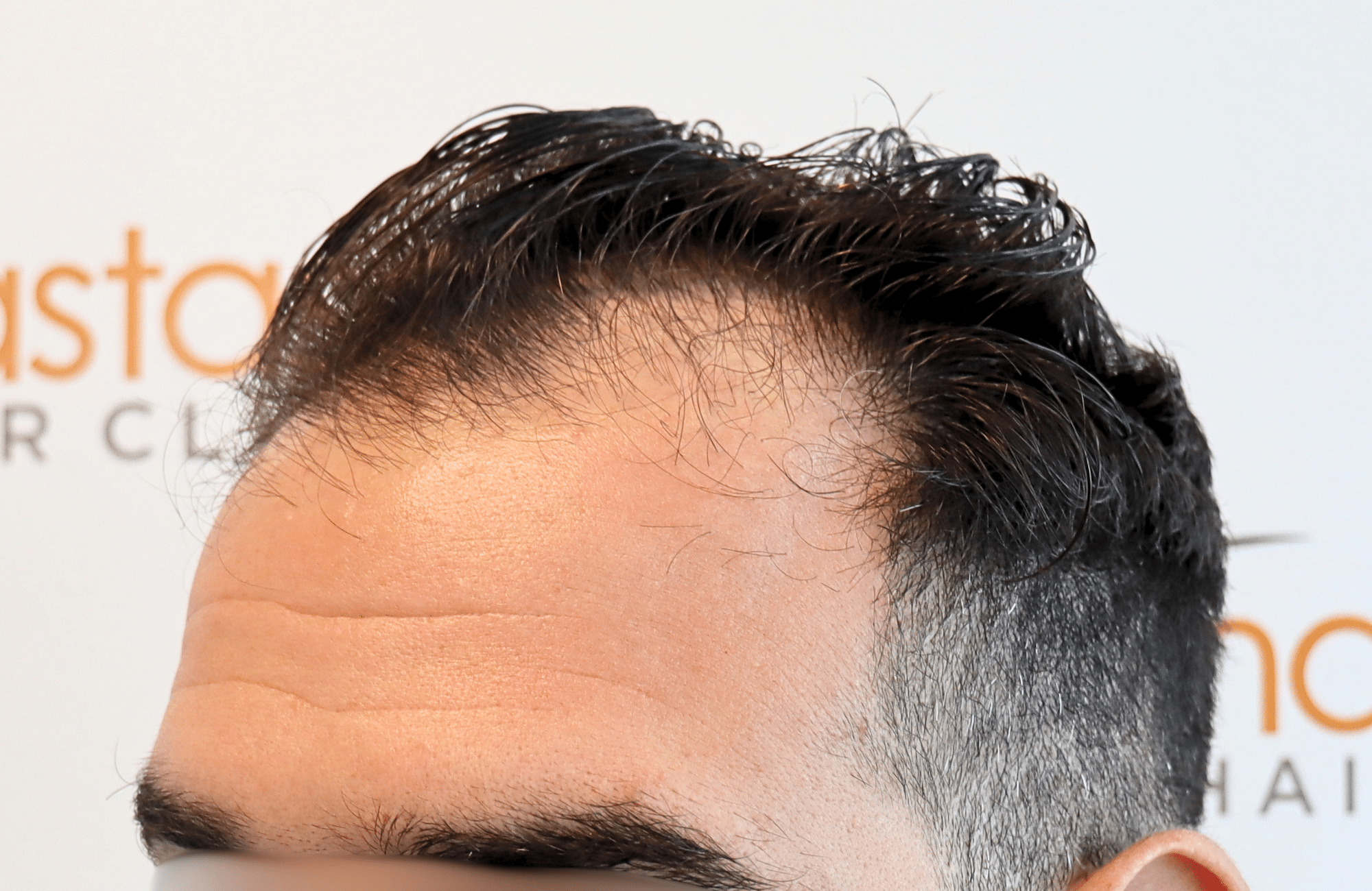 hair transplant result 2300 fus thick frontal