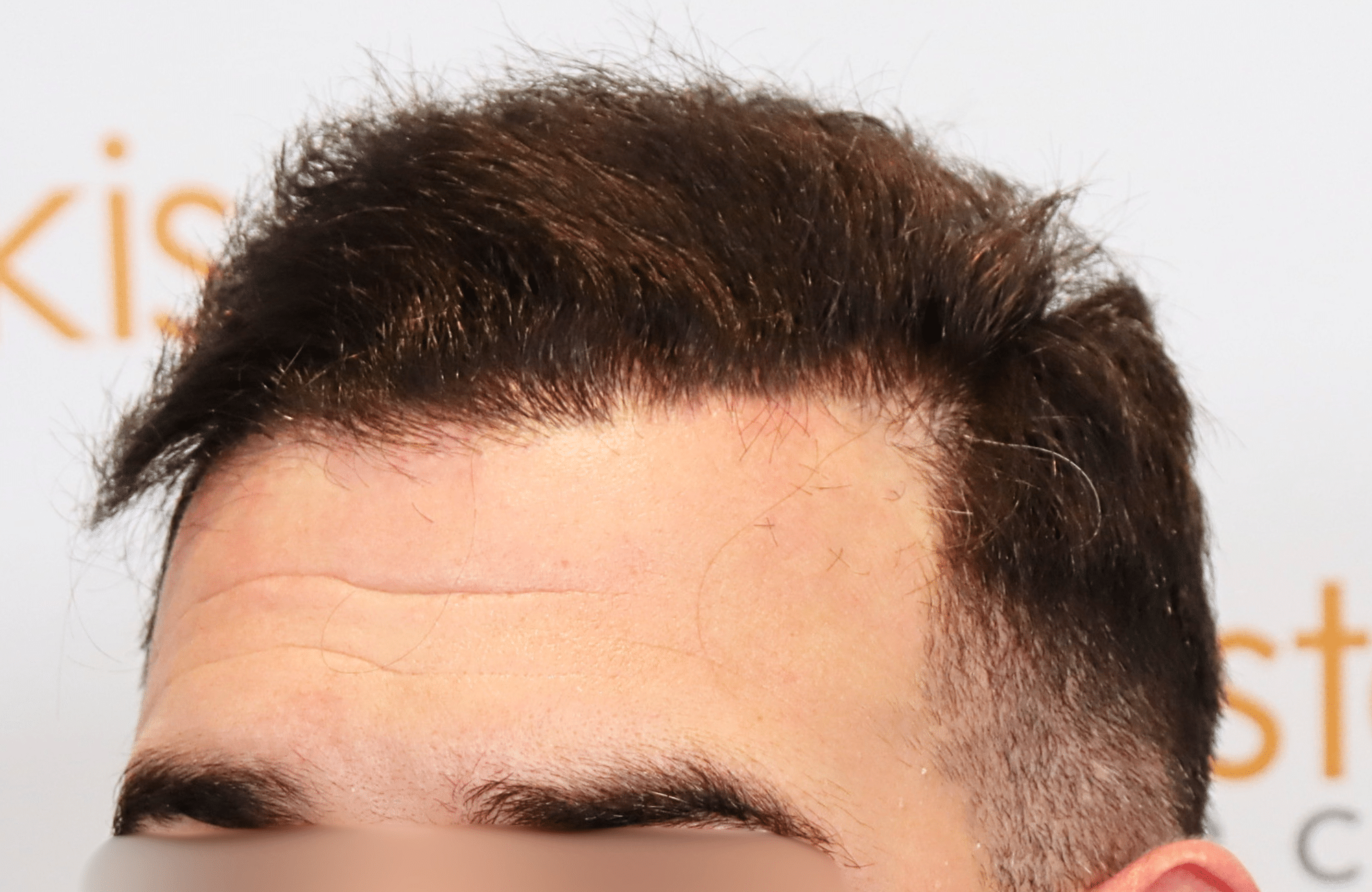 hair transplant result 2300 fus thick frontal