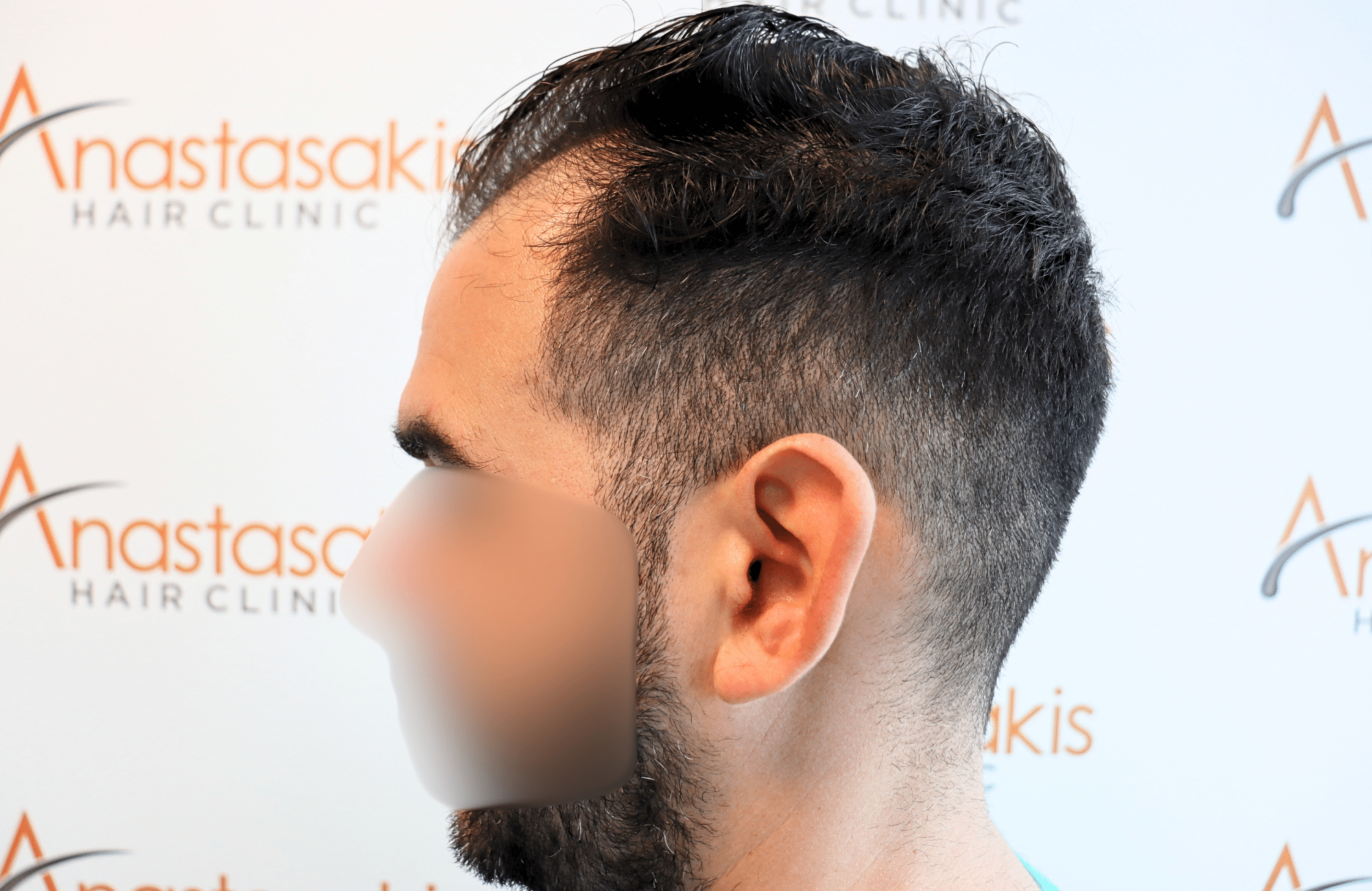 hair transplant result 2300 fus thick frontal