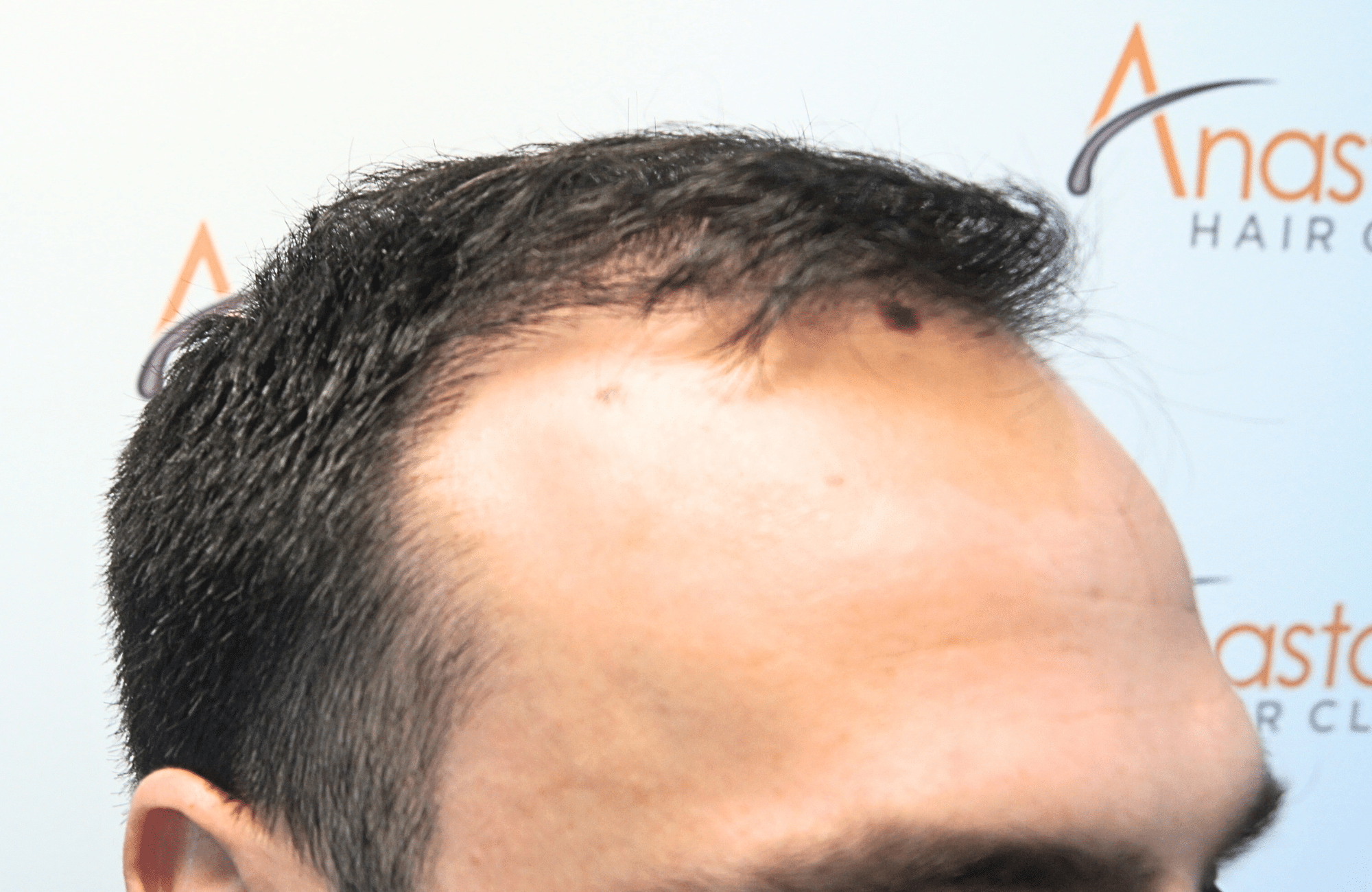 hair transplant result 2500 fus repair stage4